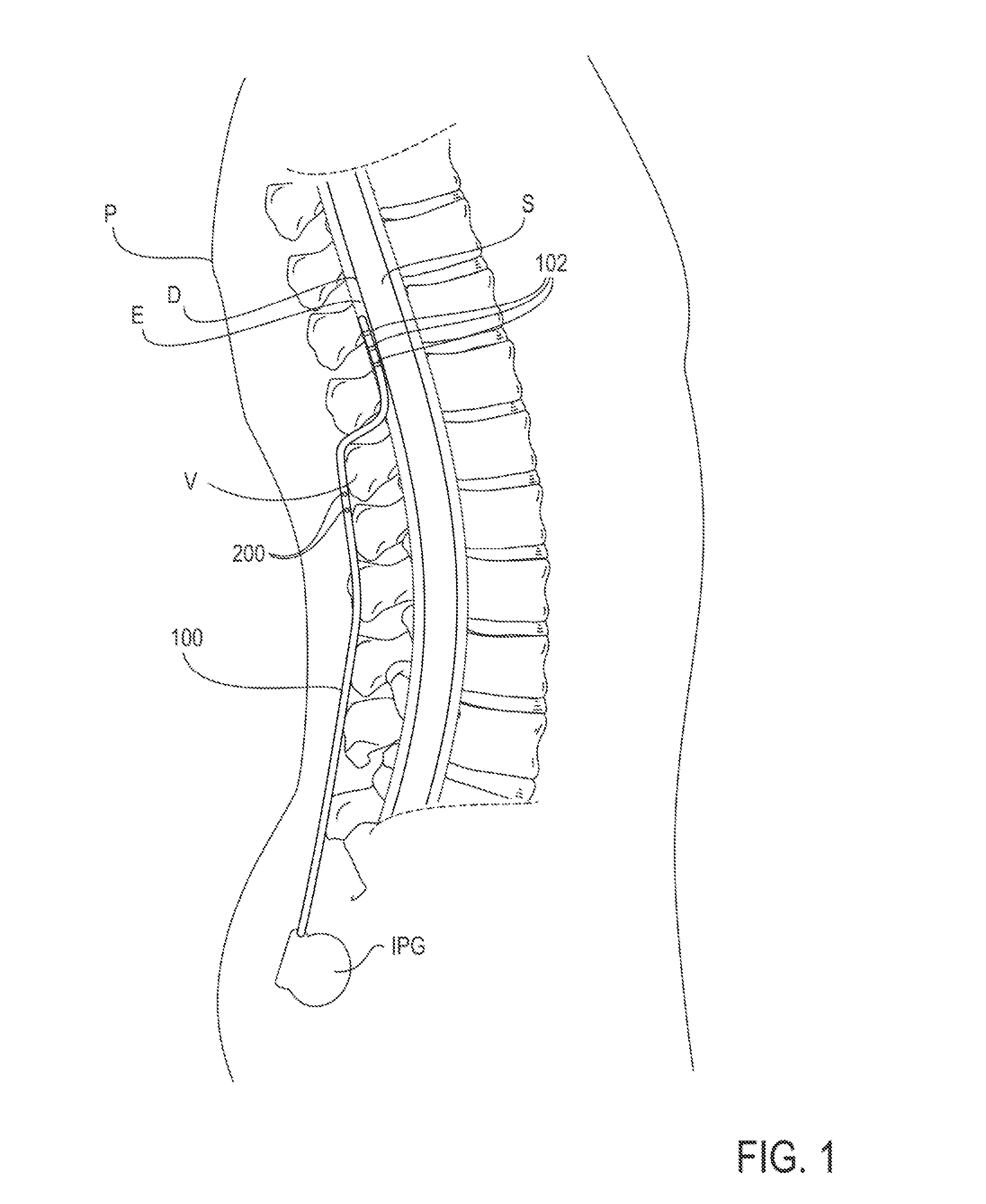 Twist-grip anchors and methods of use