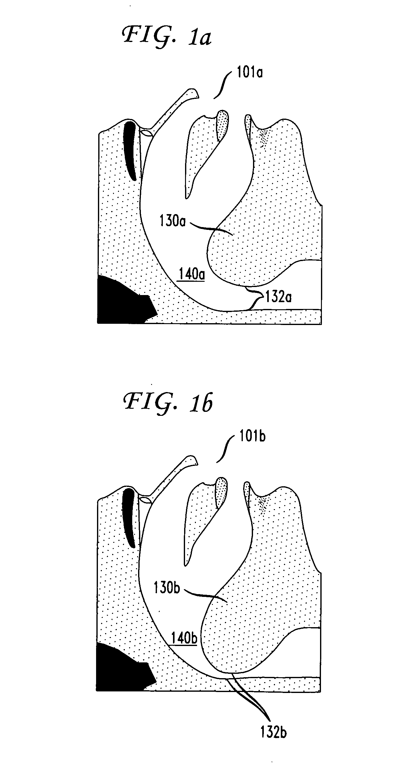 Methods and devices for treatment of obstructive sleep apnea