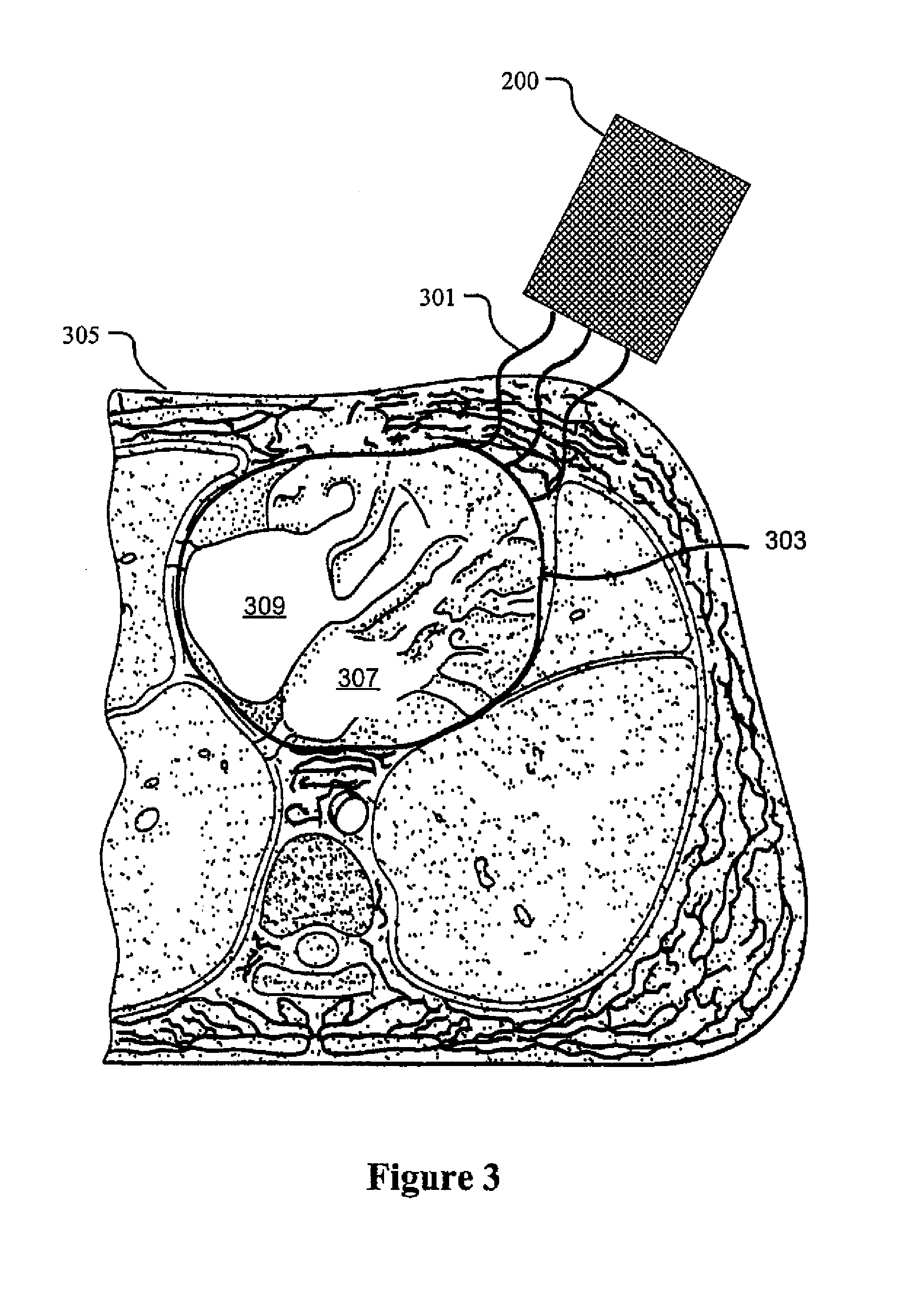 System and method for imaging myocardial infarction