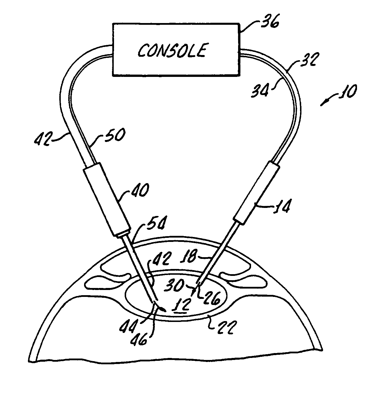 Cataract extraction apparatus and method with rapid pulse phaco power