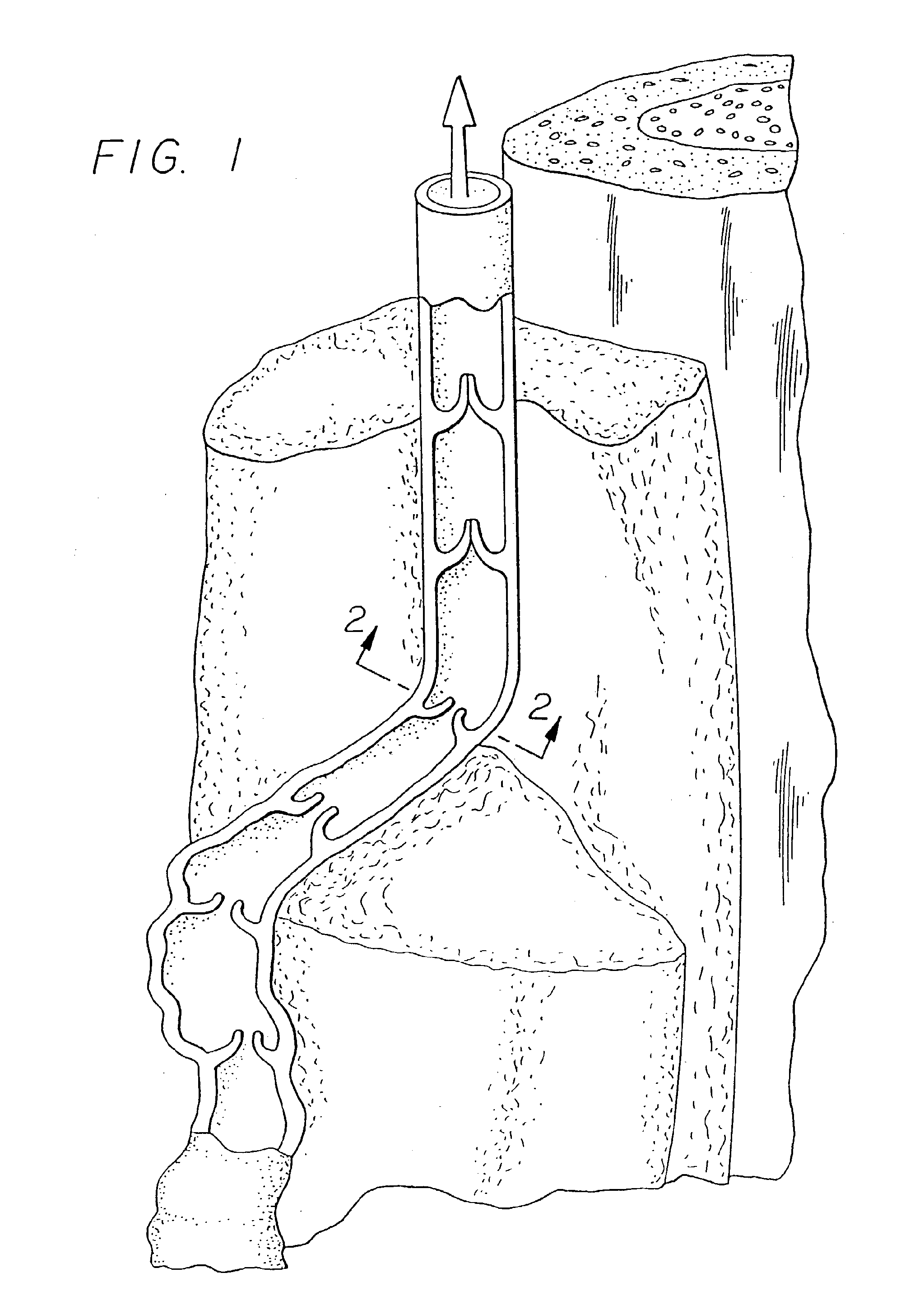 Apparatus for treating venous insufficiency