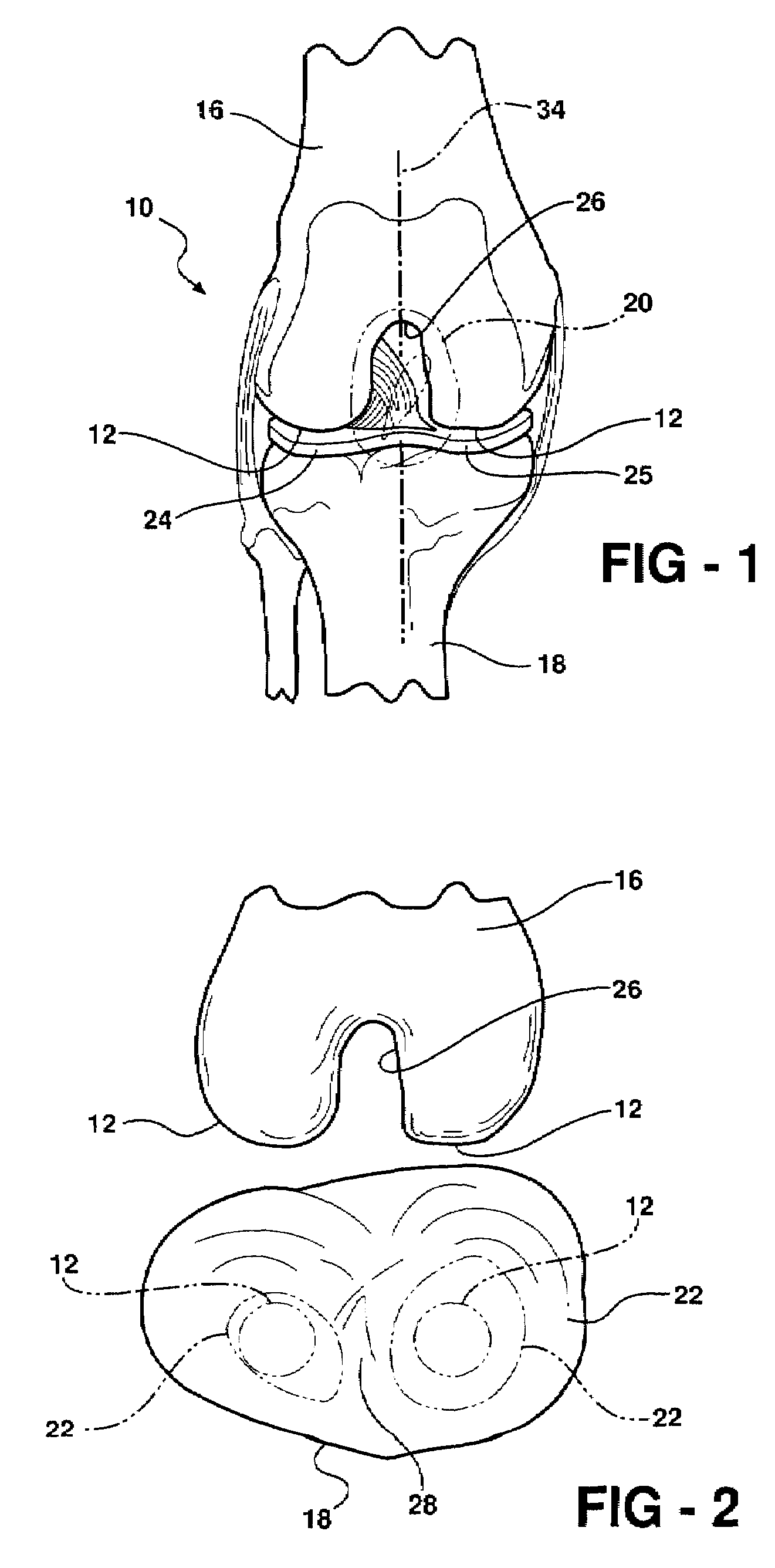 Knee brace and methods of use and modification thereof