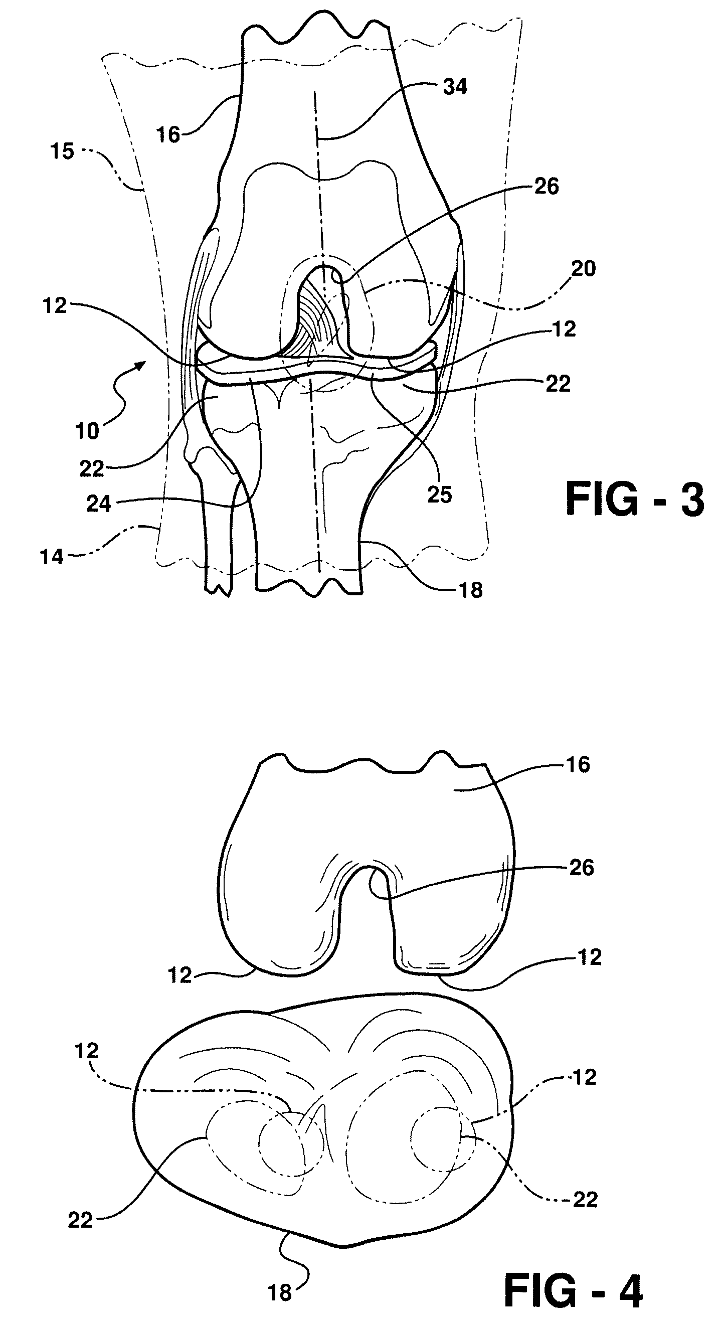 Knee brace and methods of use and modification thereof
