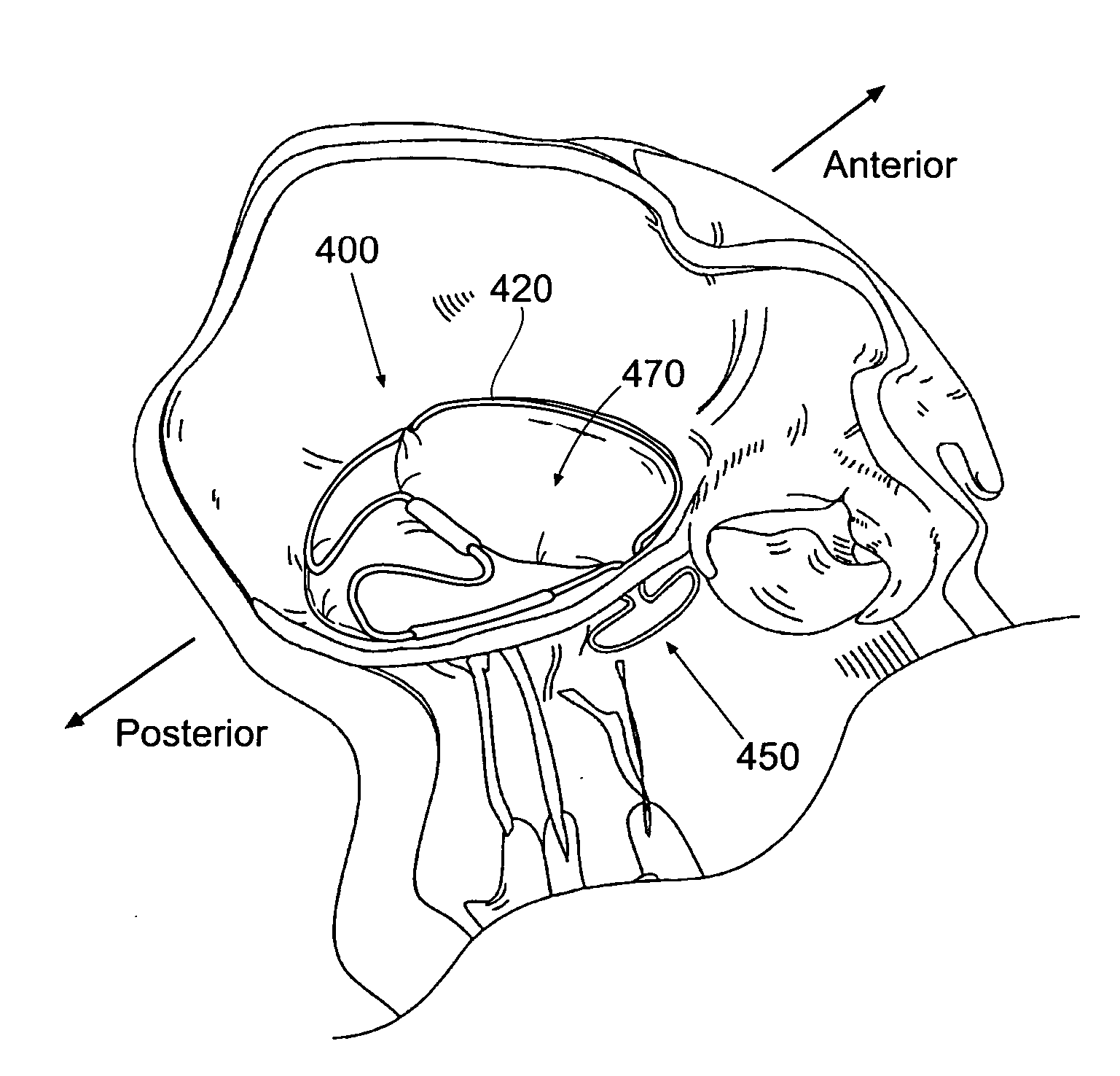 Devices, systems, and methods for supplementing, repairing, or replacing a native heart valve leaflet