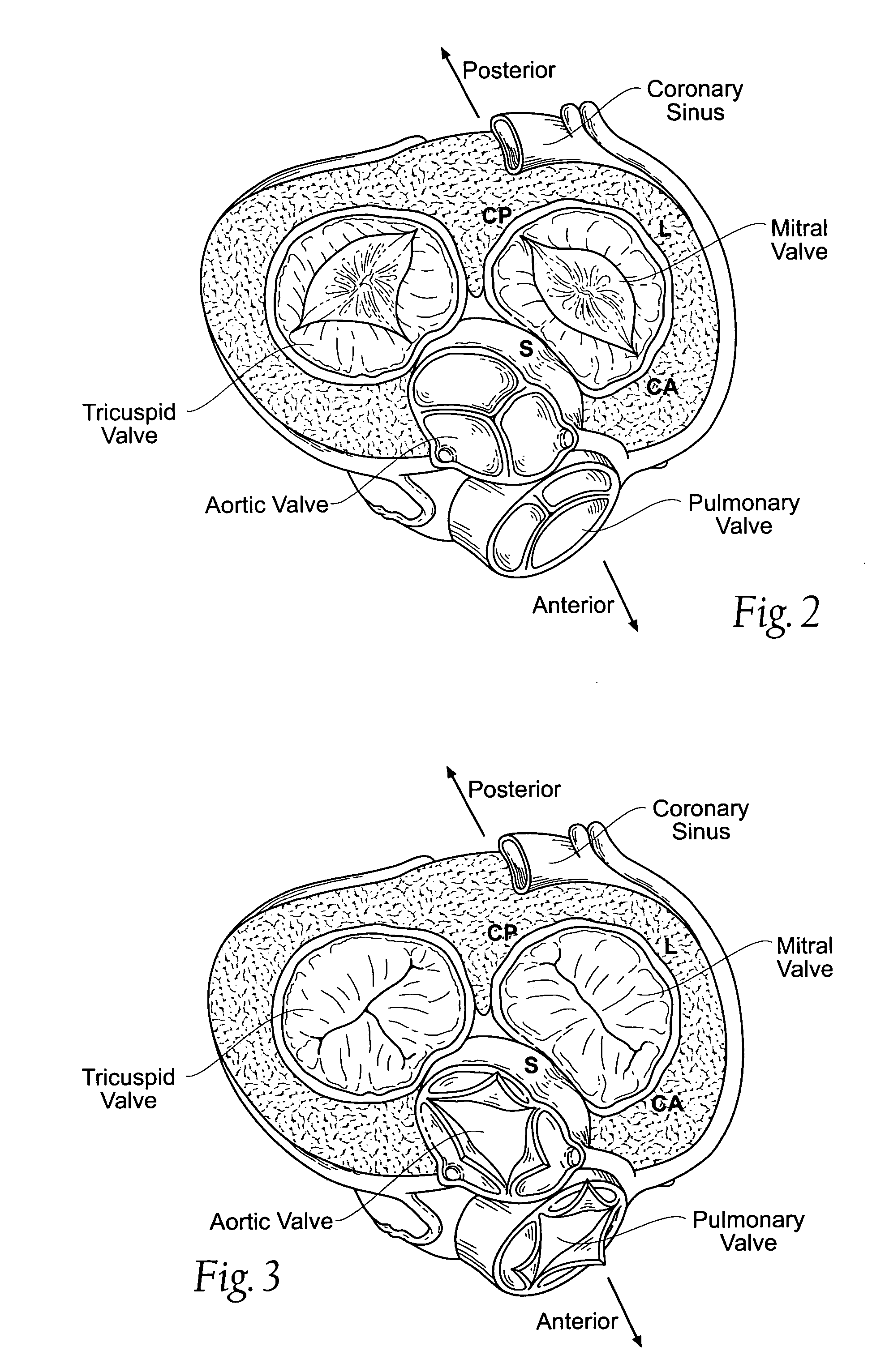 Devices, systems, and methods for supplementing, repairing, or replacing a native heart valve leaflet