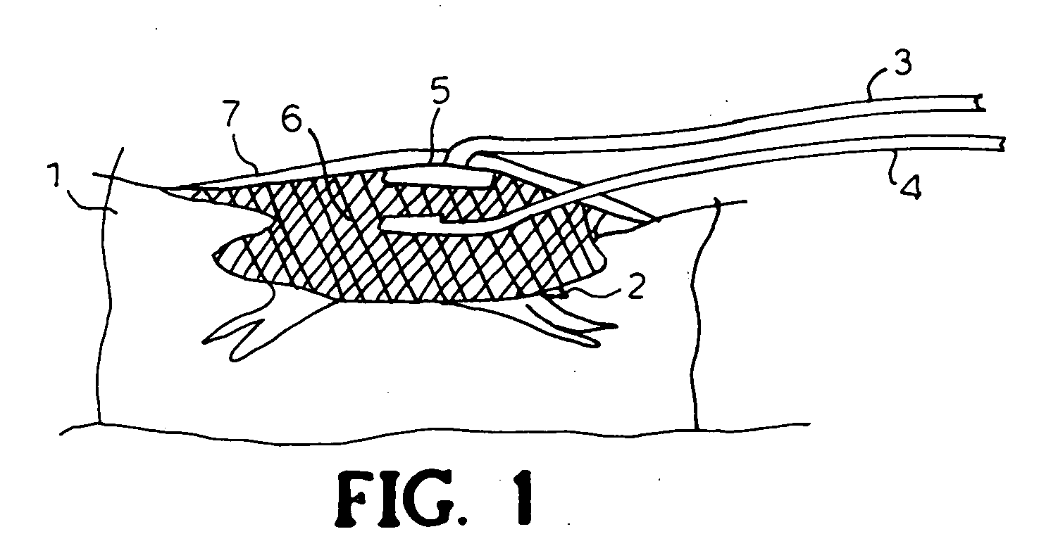 Method for dressing a wound