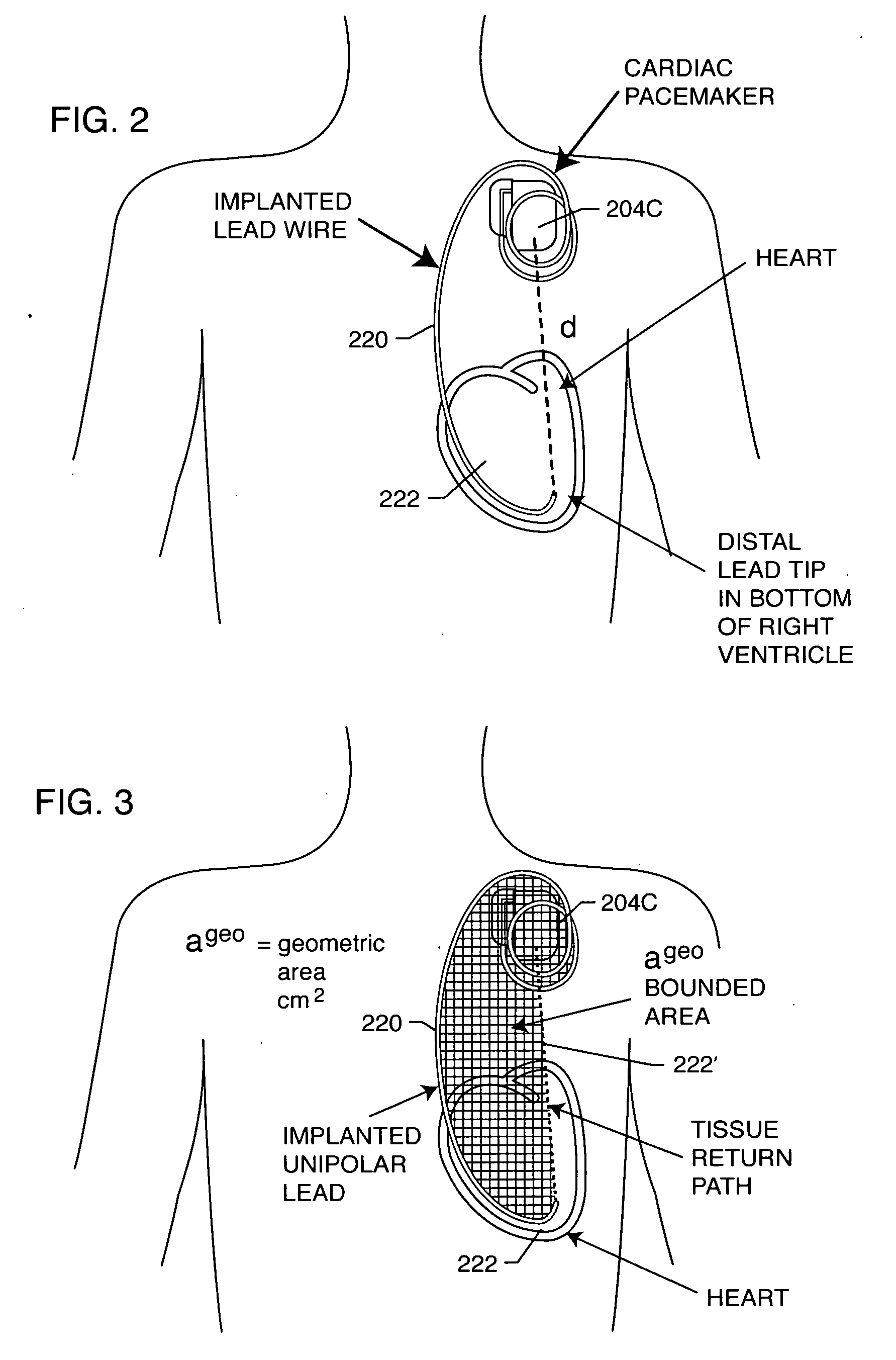 Apparatus and process for reducing the susceptability of active implantable medical devices to medical procedures such as magnetic resonance imaging