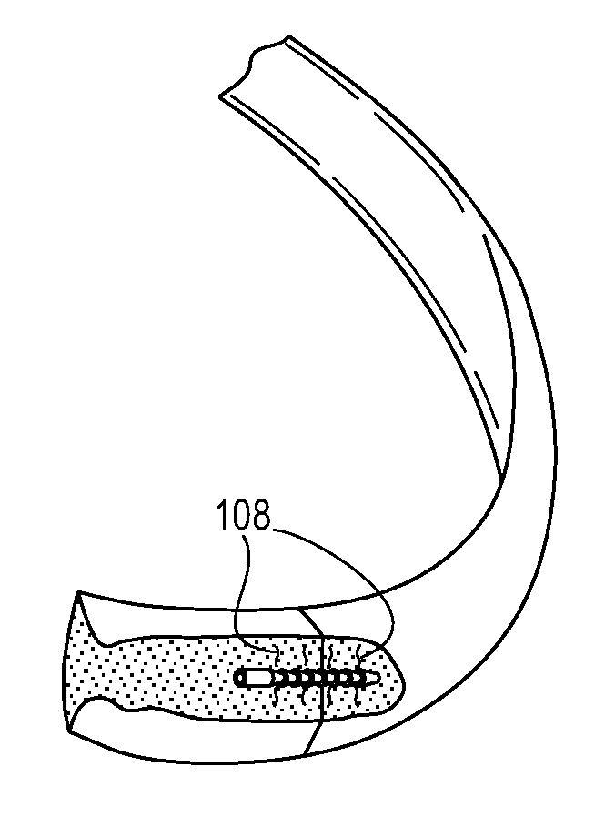 Implant and system for bone repair