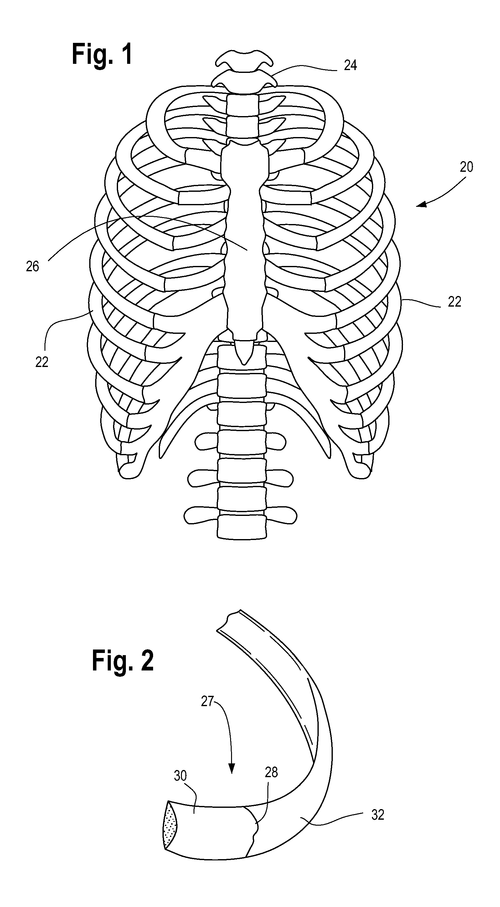 Implant and system for bone repair