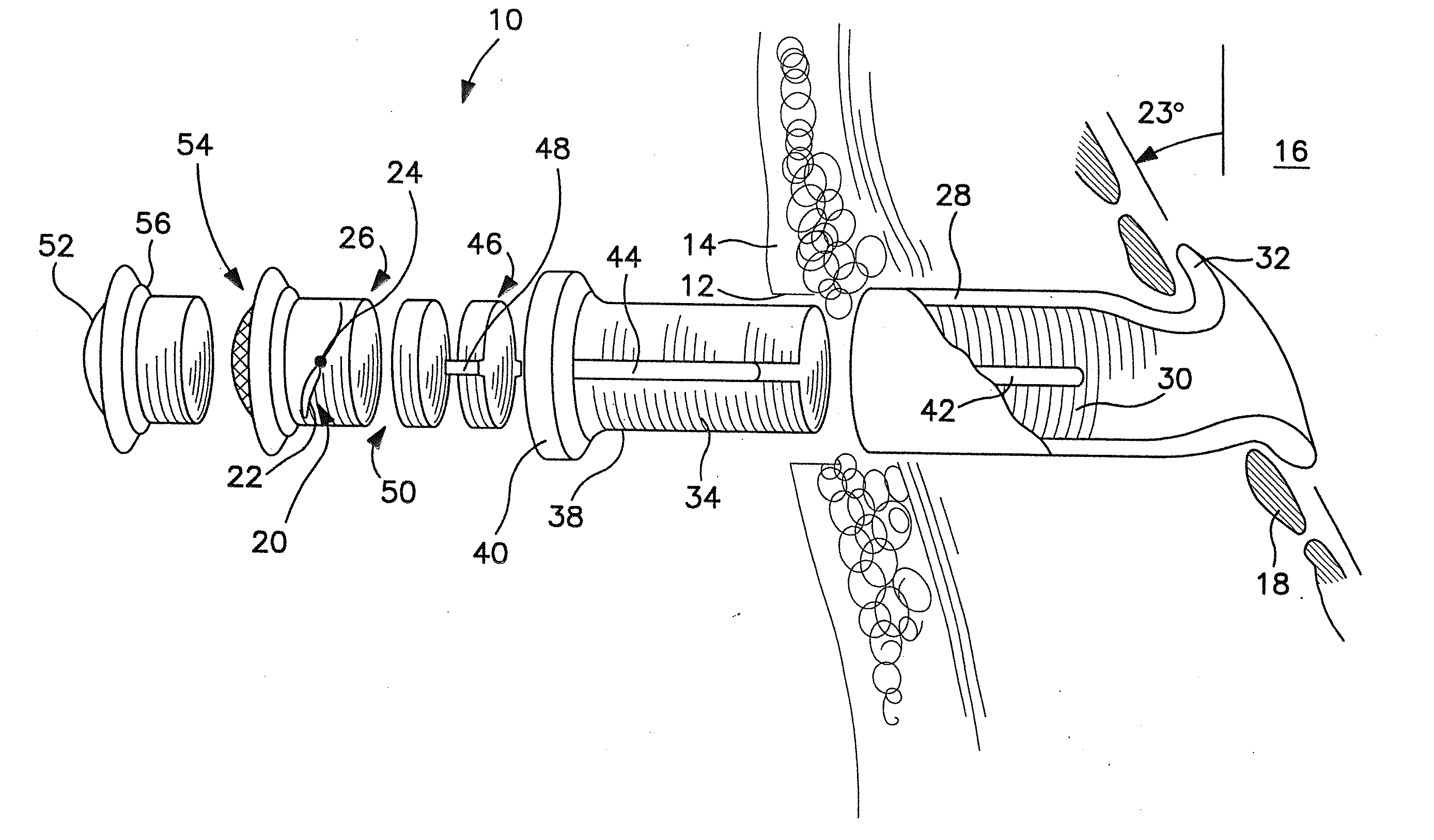 Tracheostomy Appliances and Methods for the Treatment of Sleep Apnea Syndromes