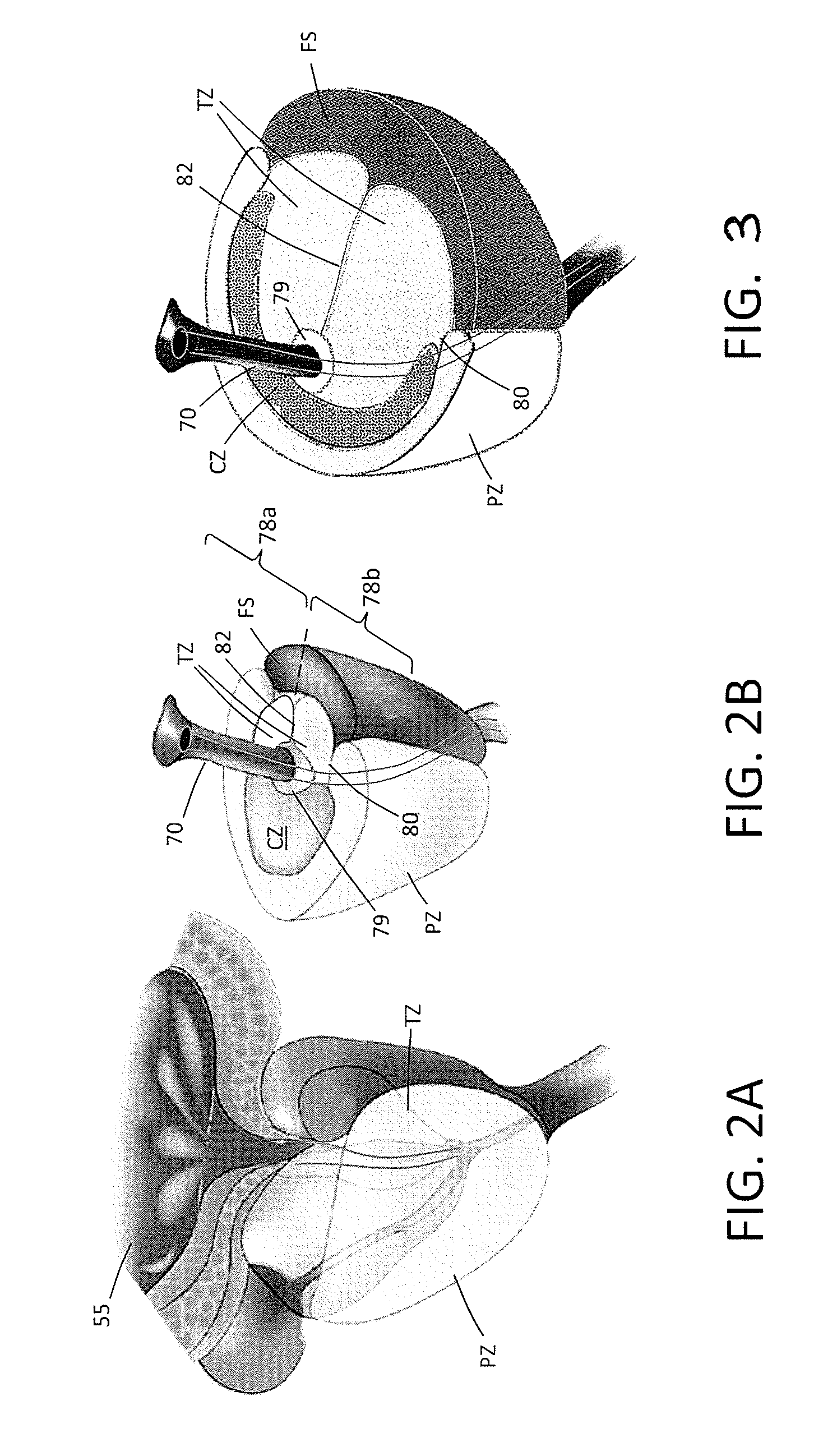 Systems and Methods for Prostate Treatment