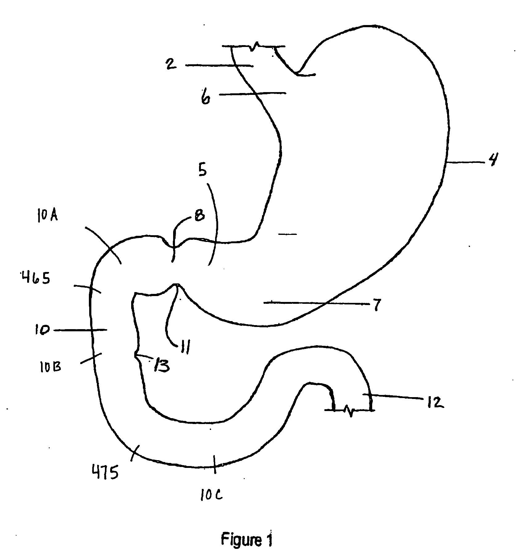 Methods and devices to curb appetite and/or reduce food intake