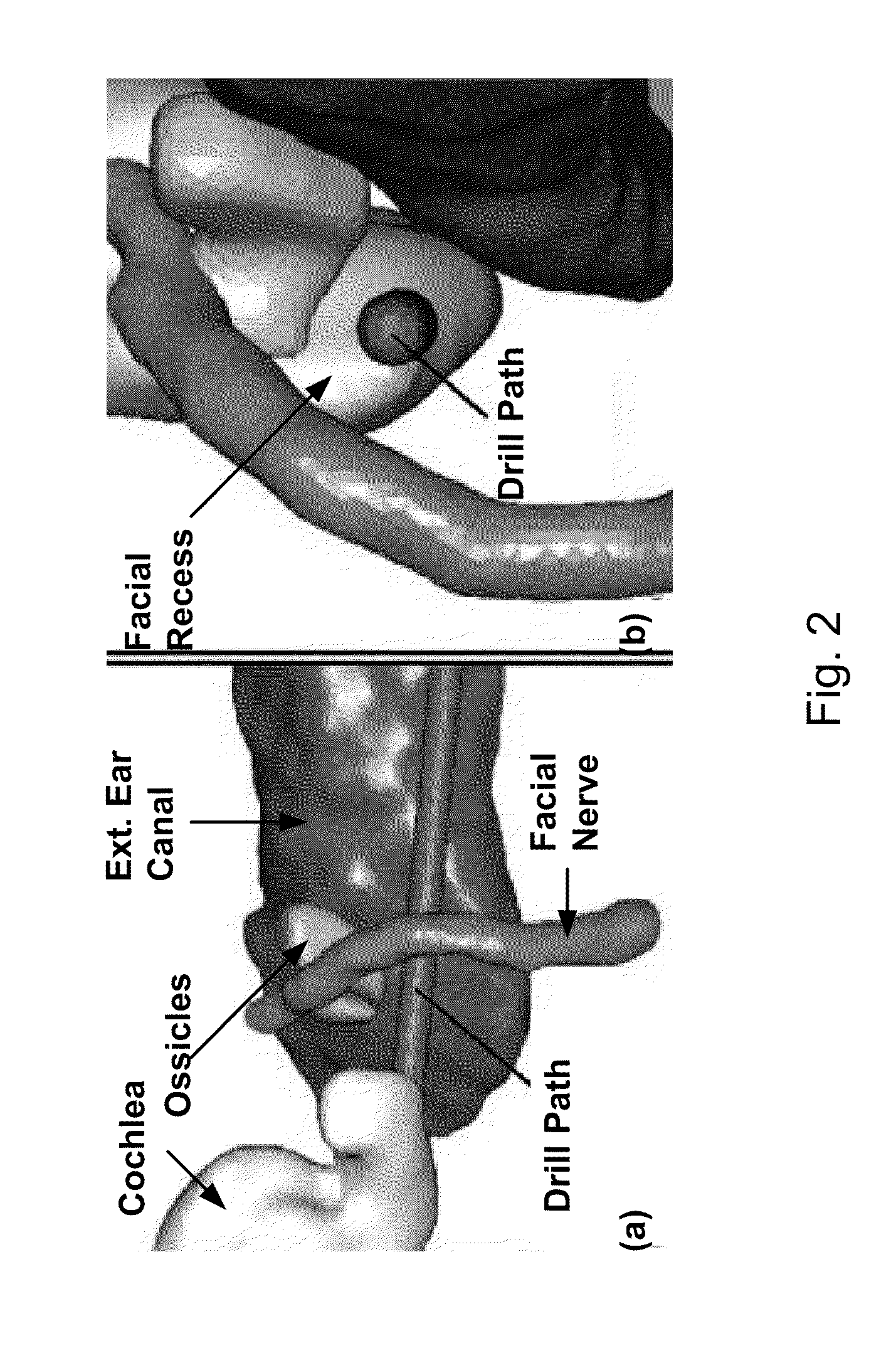 Apparatus and methods for percutaneous cochlear implantation