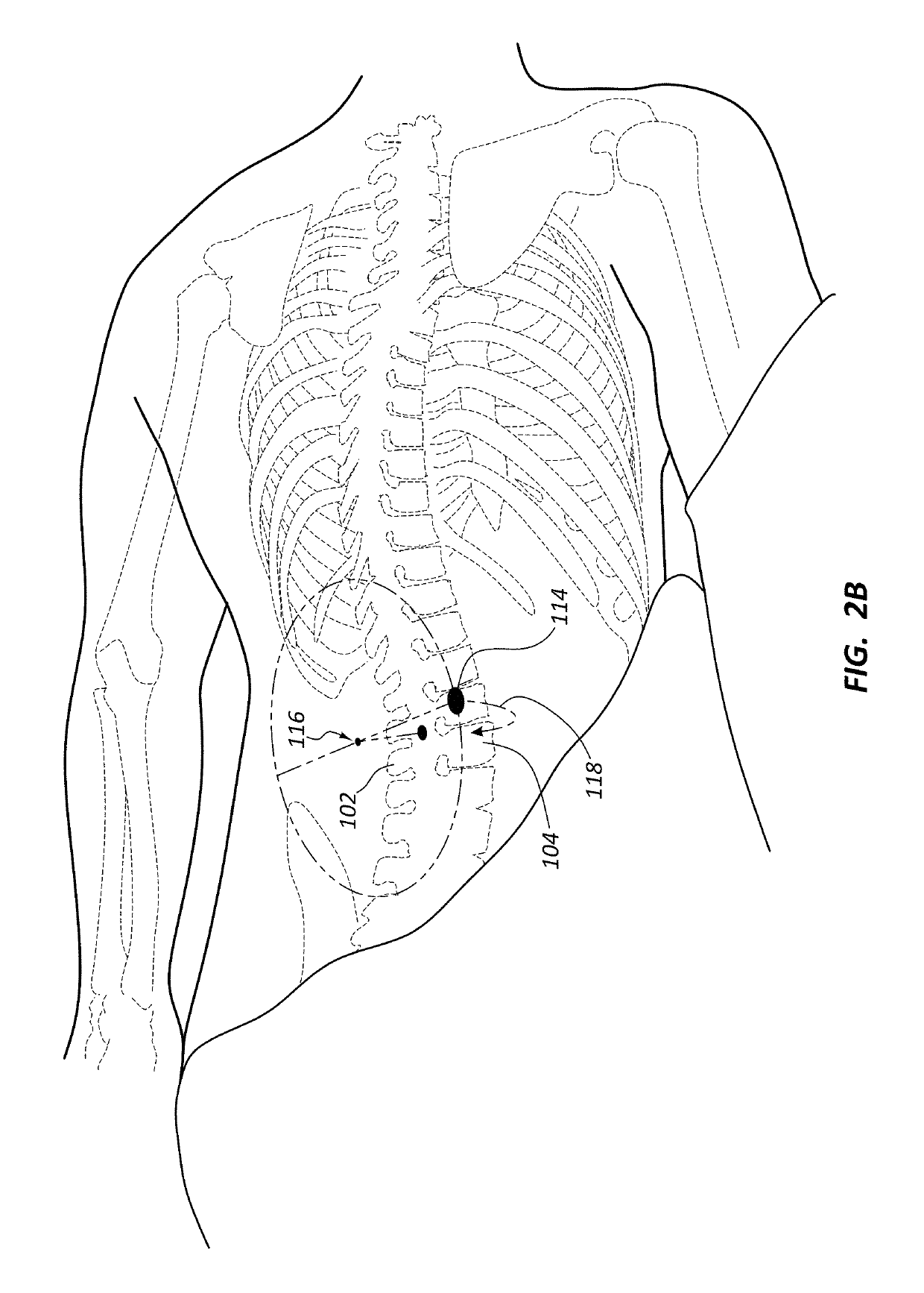Posterior to lateral interbody fusion approach with associated instrumentation and implants