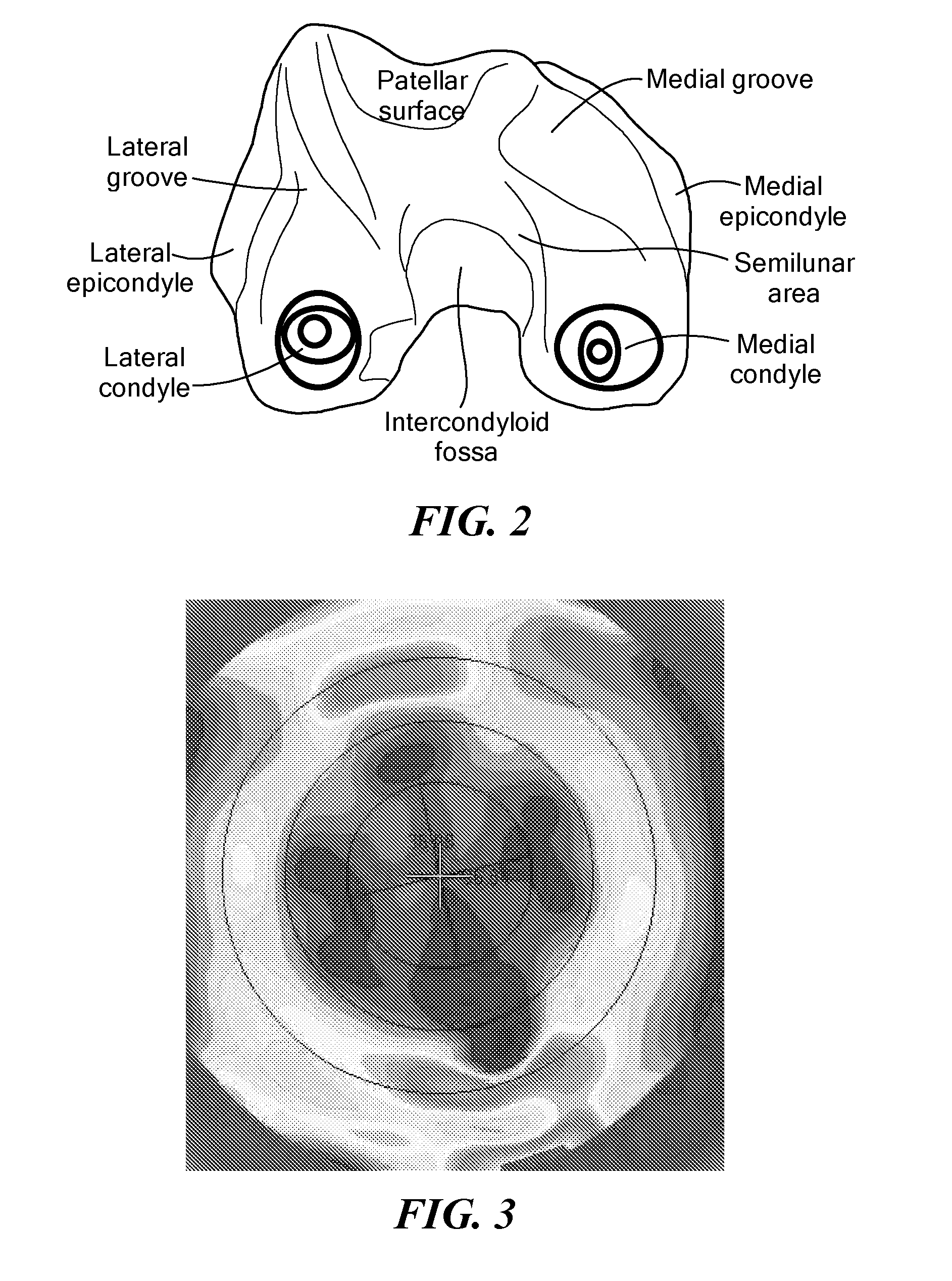 Methods for Determining Meniscal Size and Shape and for Devising Treatment