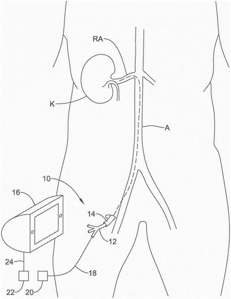 Medical device for sympathetic nerve ablation with printed components