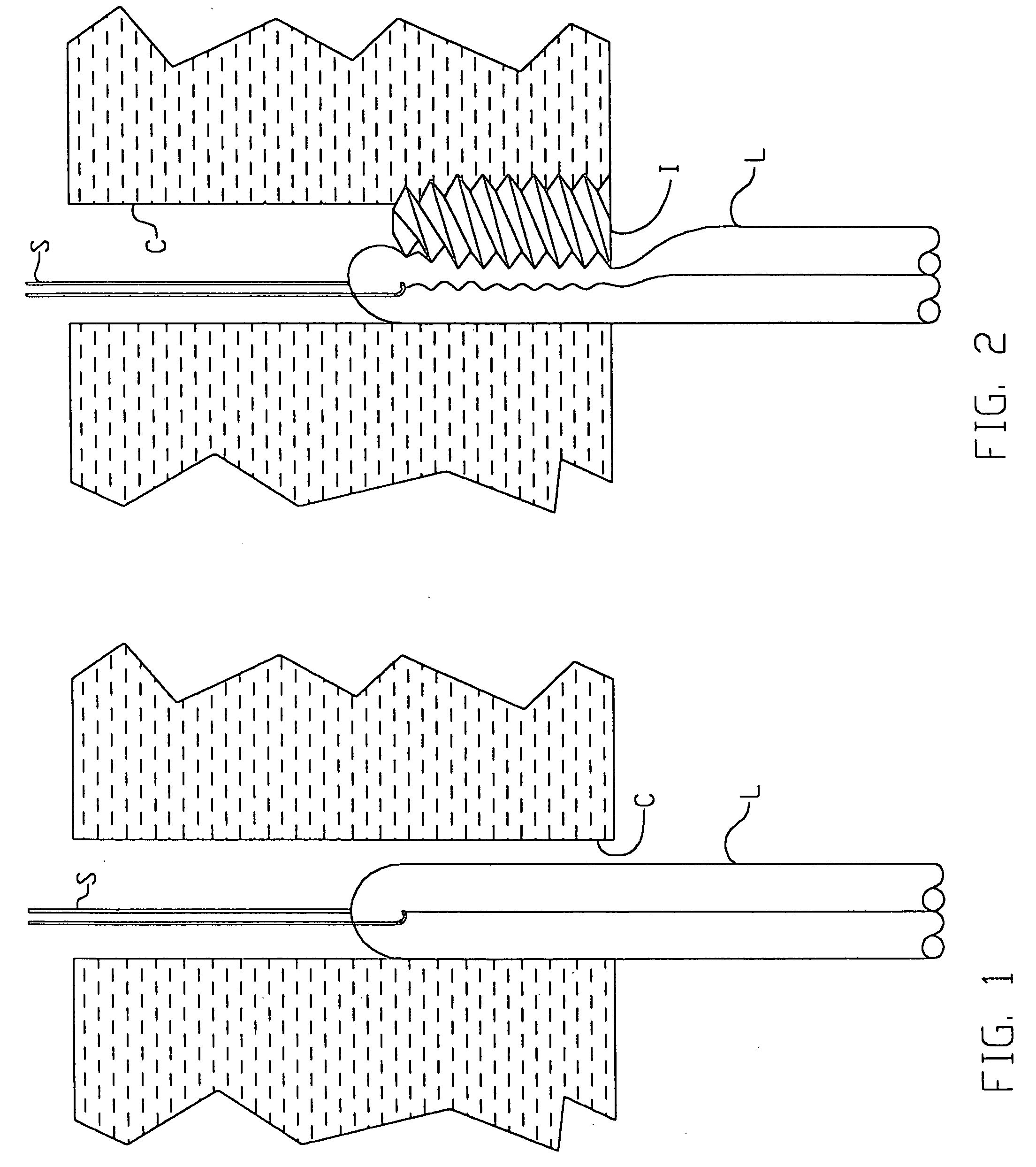 Apparatus and method for ligament fixation