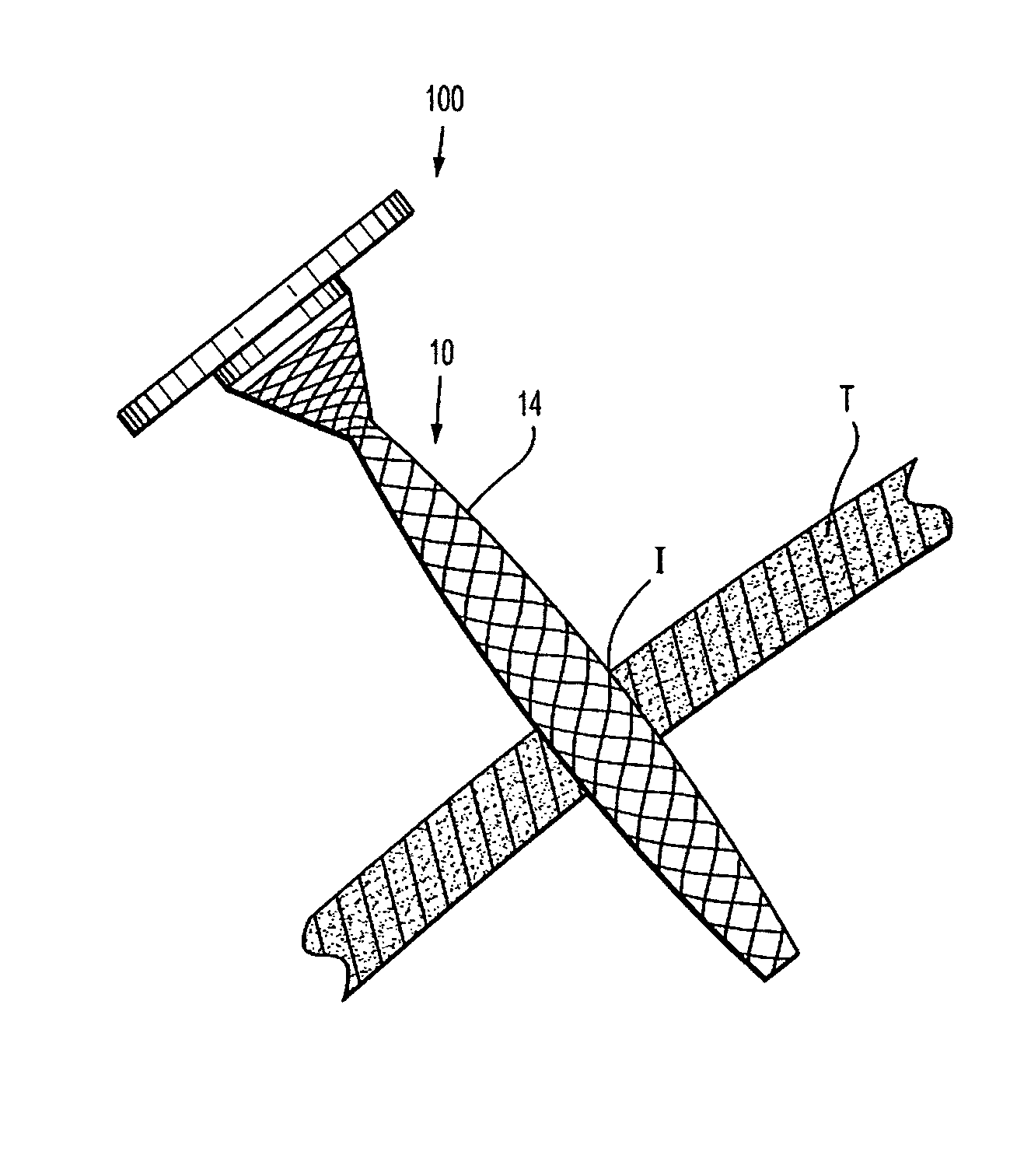 Wound Closure Device Including Suction Step Sleeve