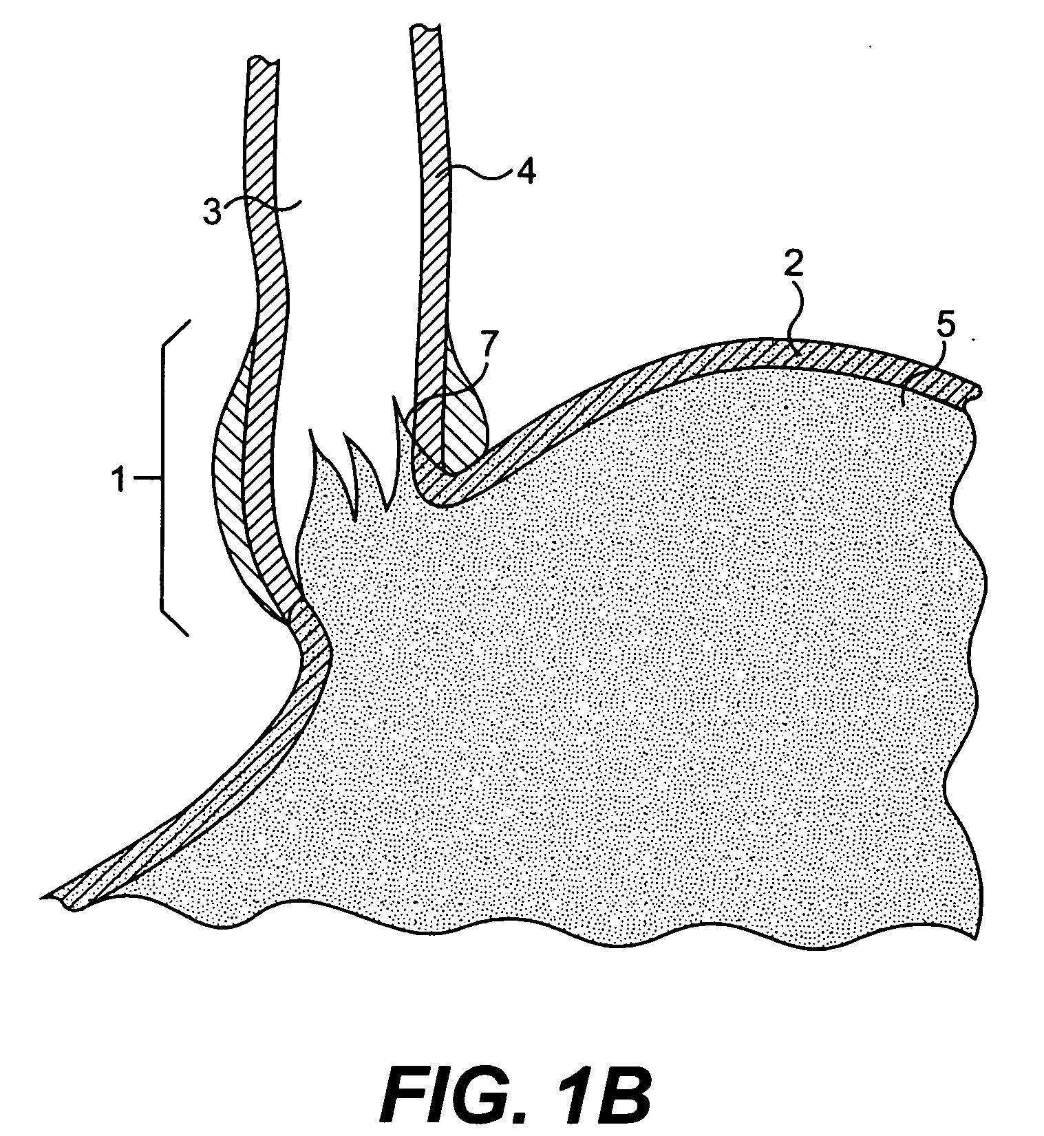 Tissue patches and related delivery systems and methods