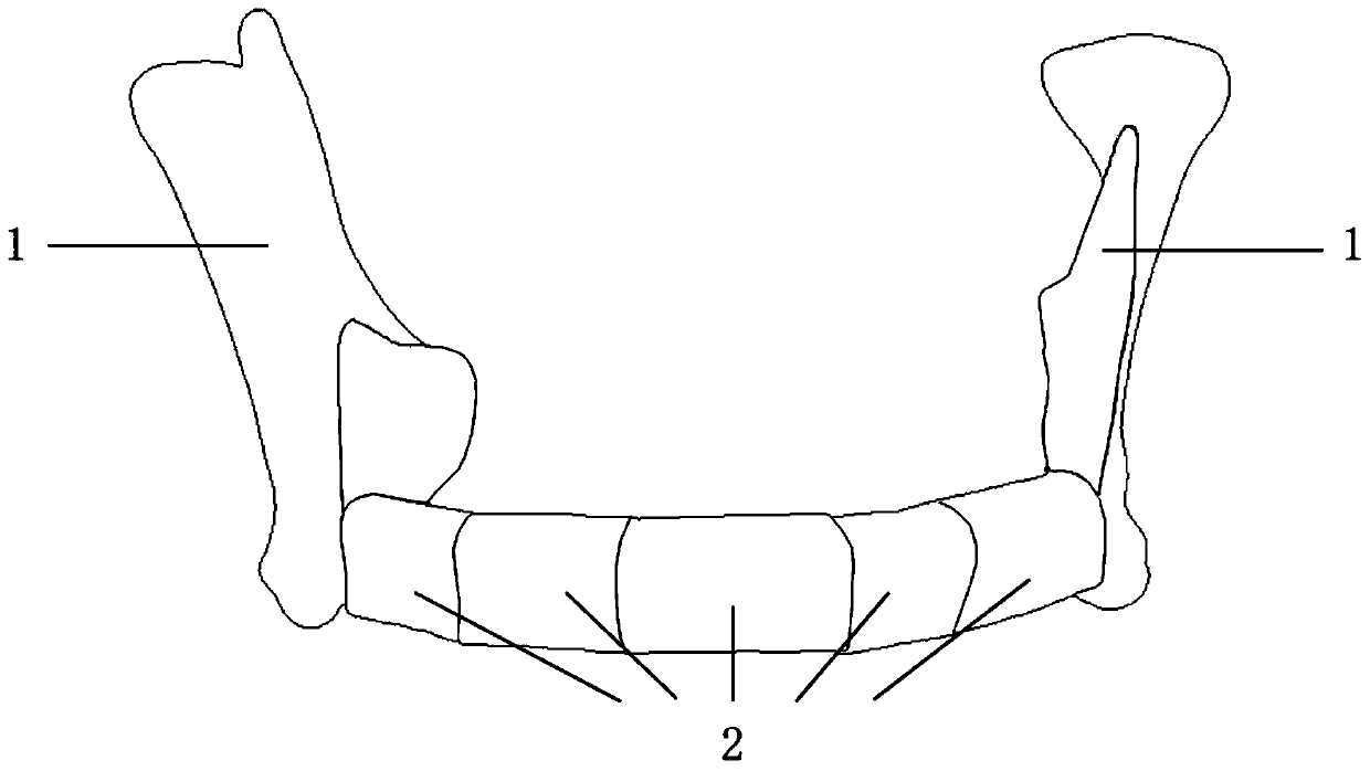 Construction method of individualized mandible defect reconstruction guide plate system