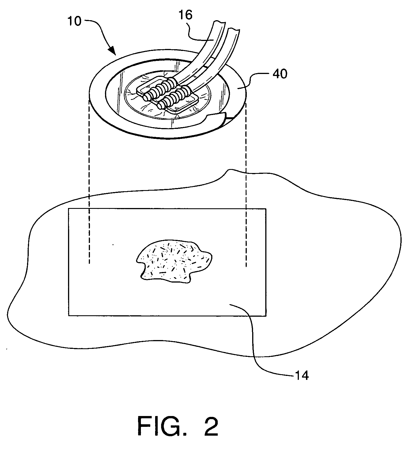 Tube attachment device for wound treatment
