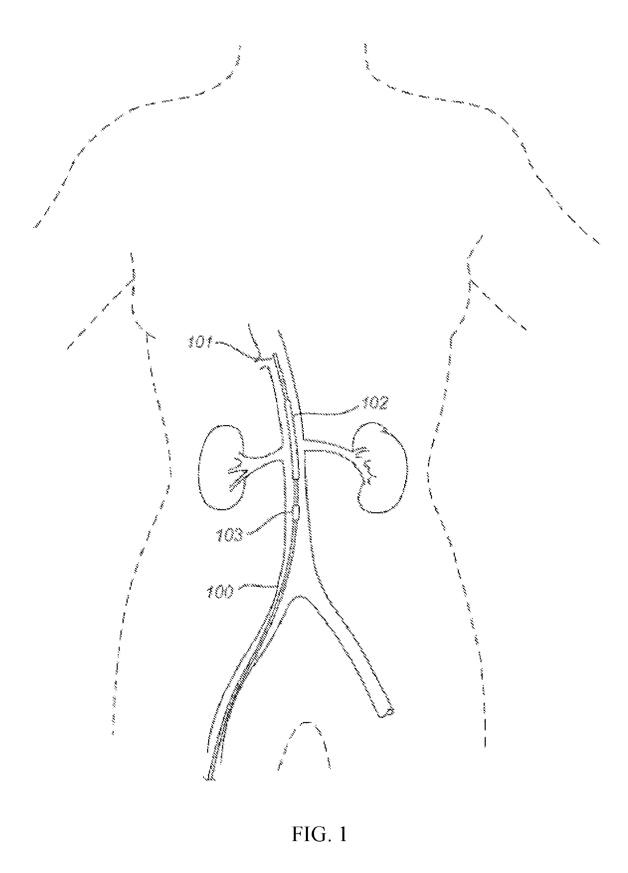 Devices and methods for treating acute kidney injury