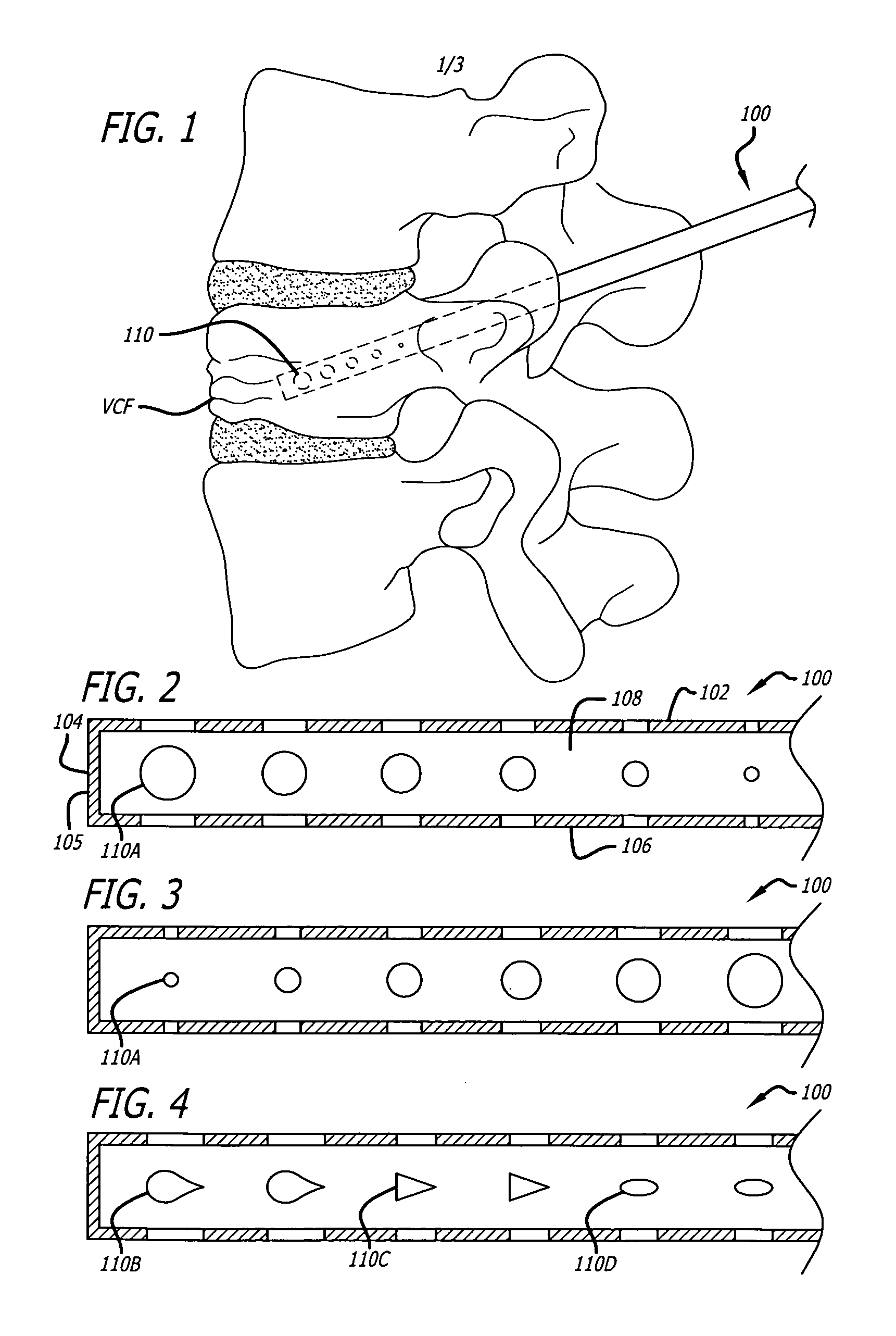 Vented directional delivery cannula with openings of different size for use with flowable materials and method for use thereof