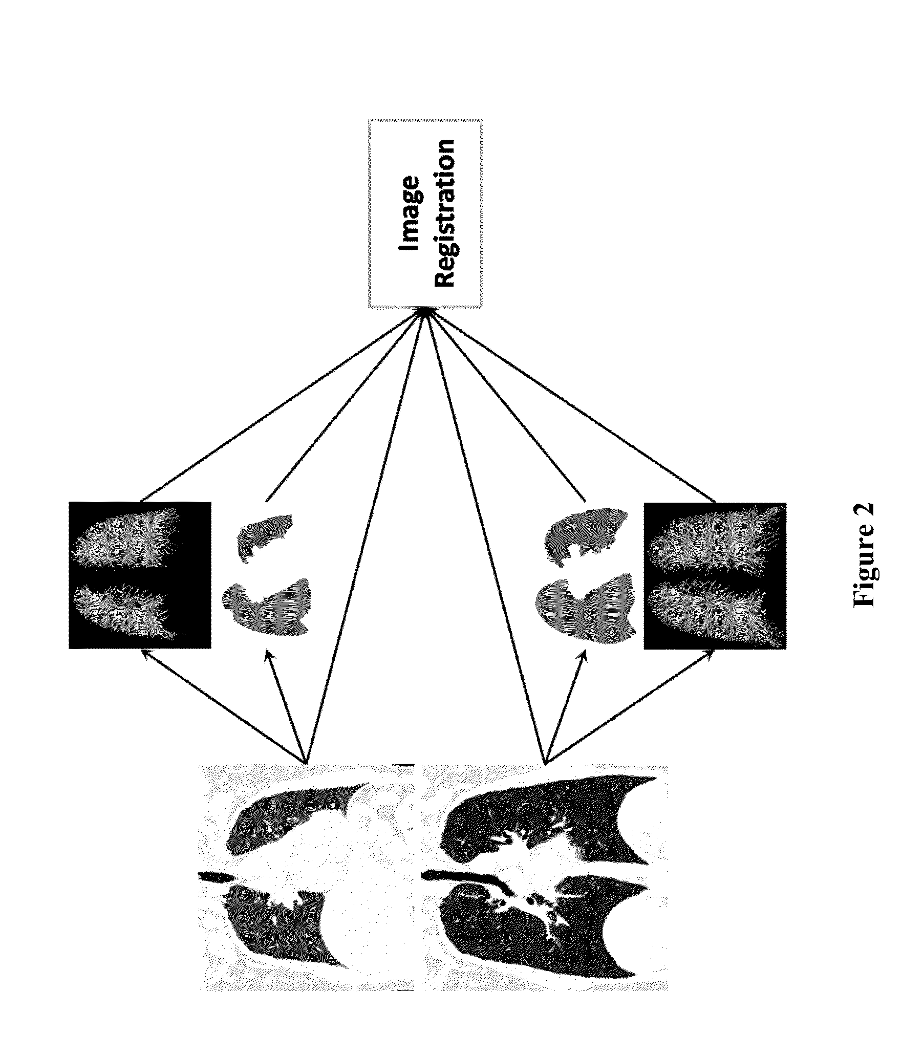 Visualization and quantification of lung disease utilizing image registration