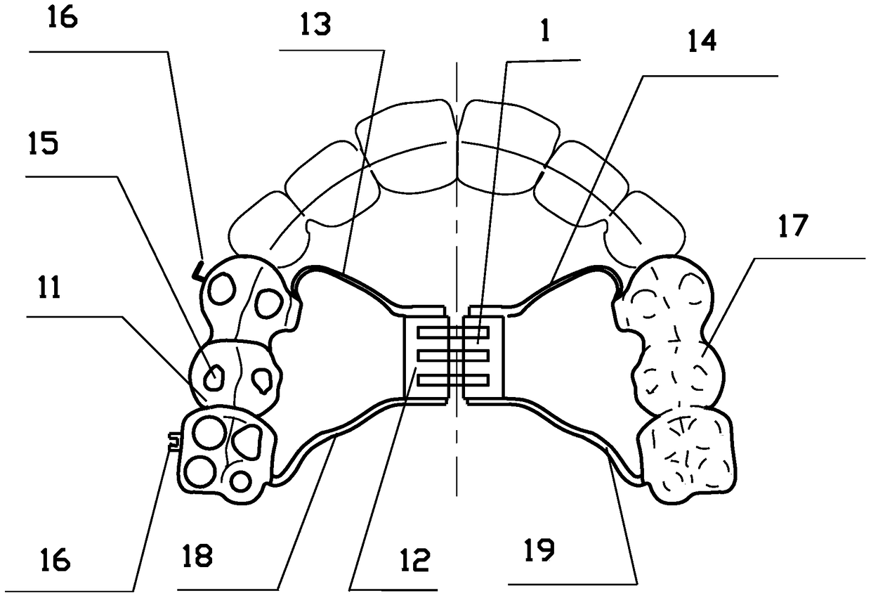 Fixed asymmetrical occlusal pad combined with cast crown to release interlocking device