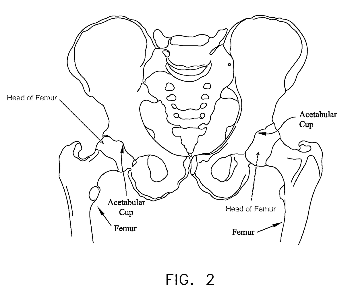 Method and apparatus for reconstructing a hip joint, including the provision and use of a novel arthroscopic debridement template for assisting in the treatment of cam-type femoroacetabular impingement