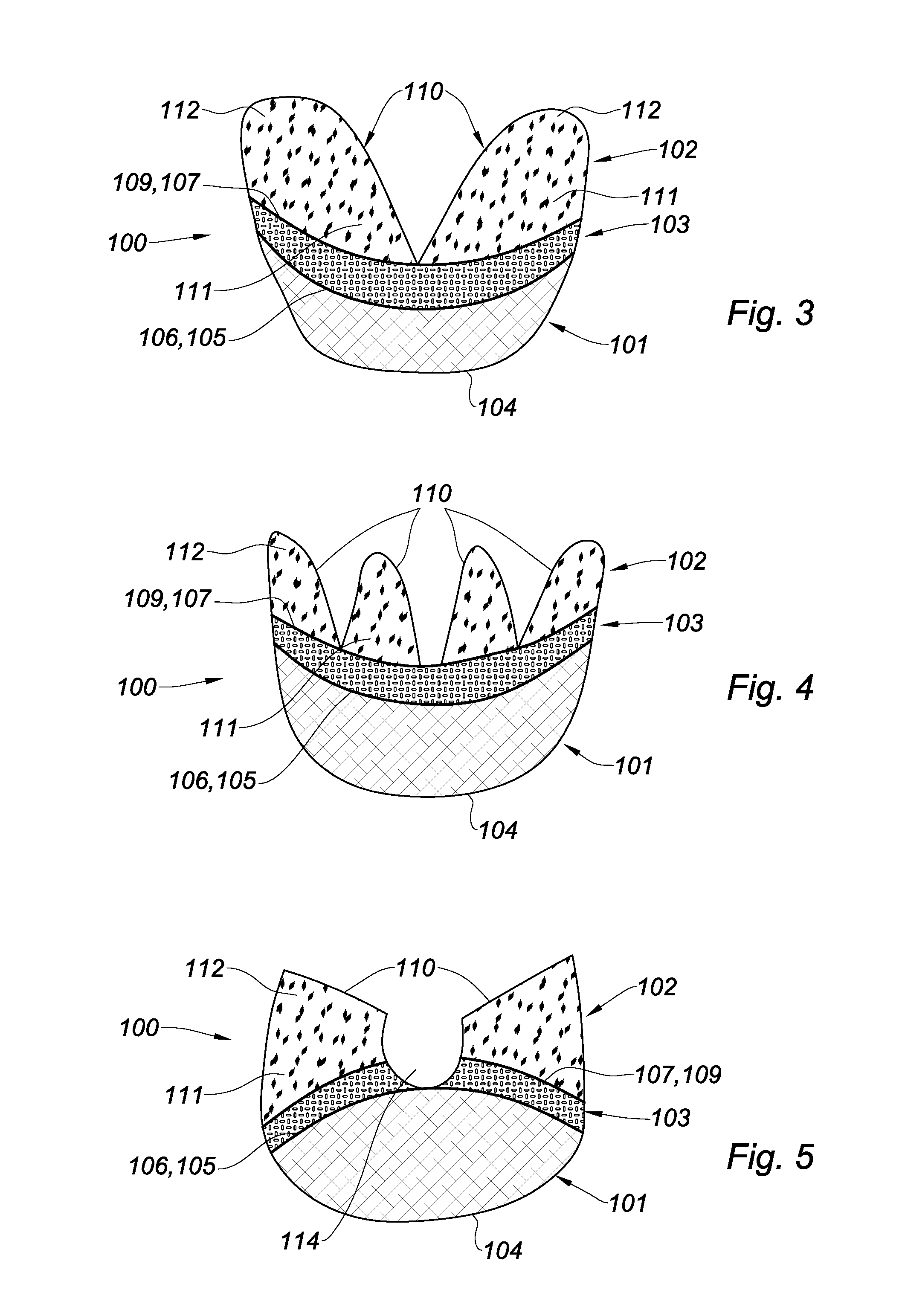 Prosthesis for supporting a breast structure