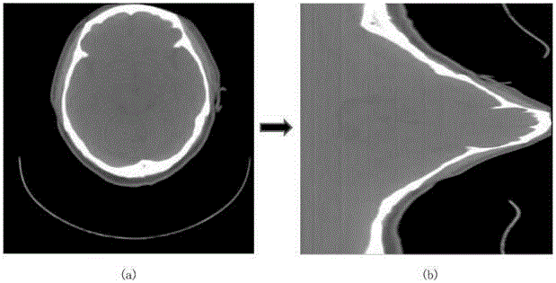 Ring artifact elimination method for CBCT image