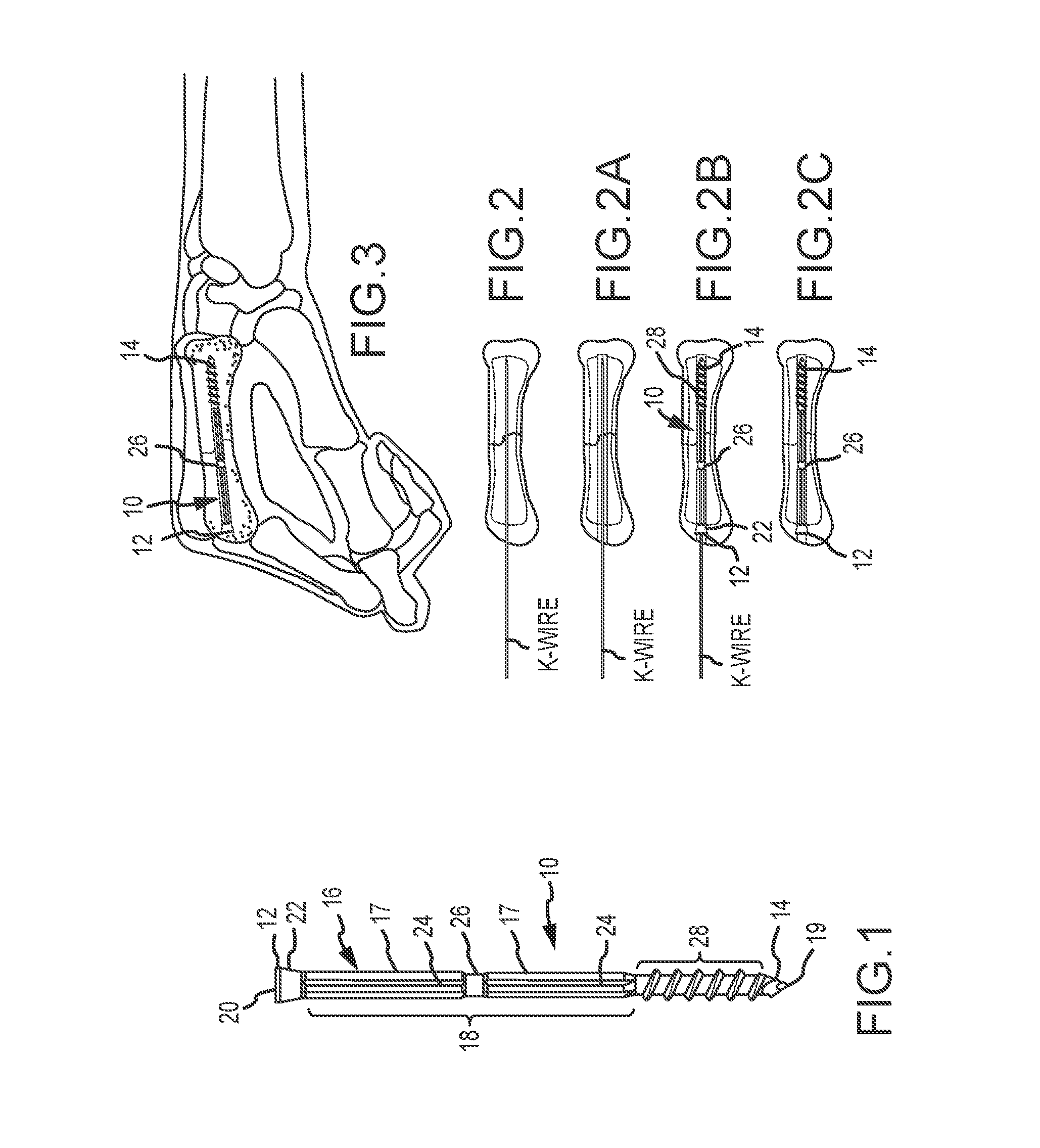 Metacarpal bone stabilization device