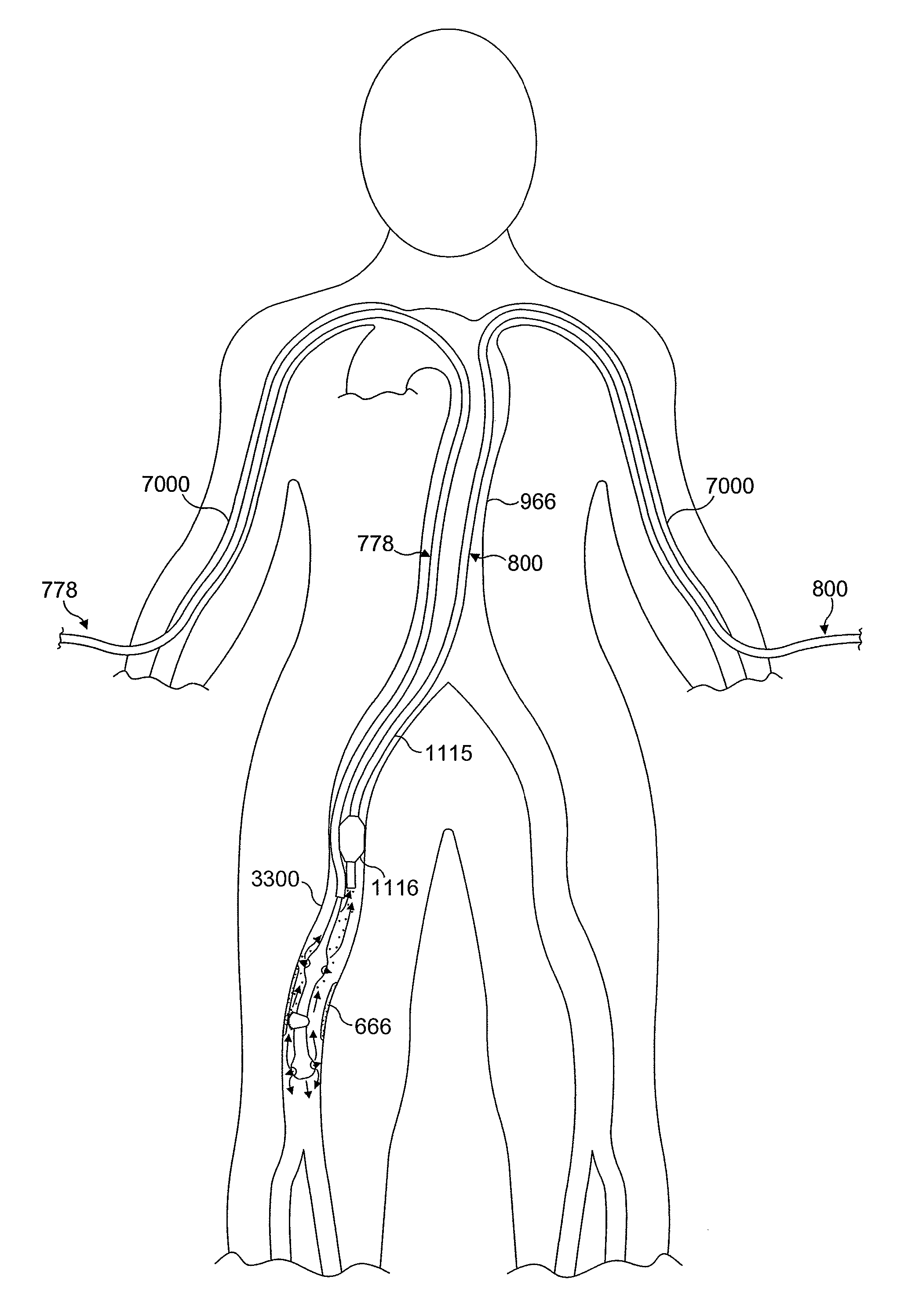 Rotational atherectomy system with enhanced distal protection capability and method of use