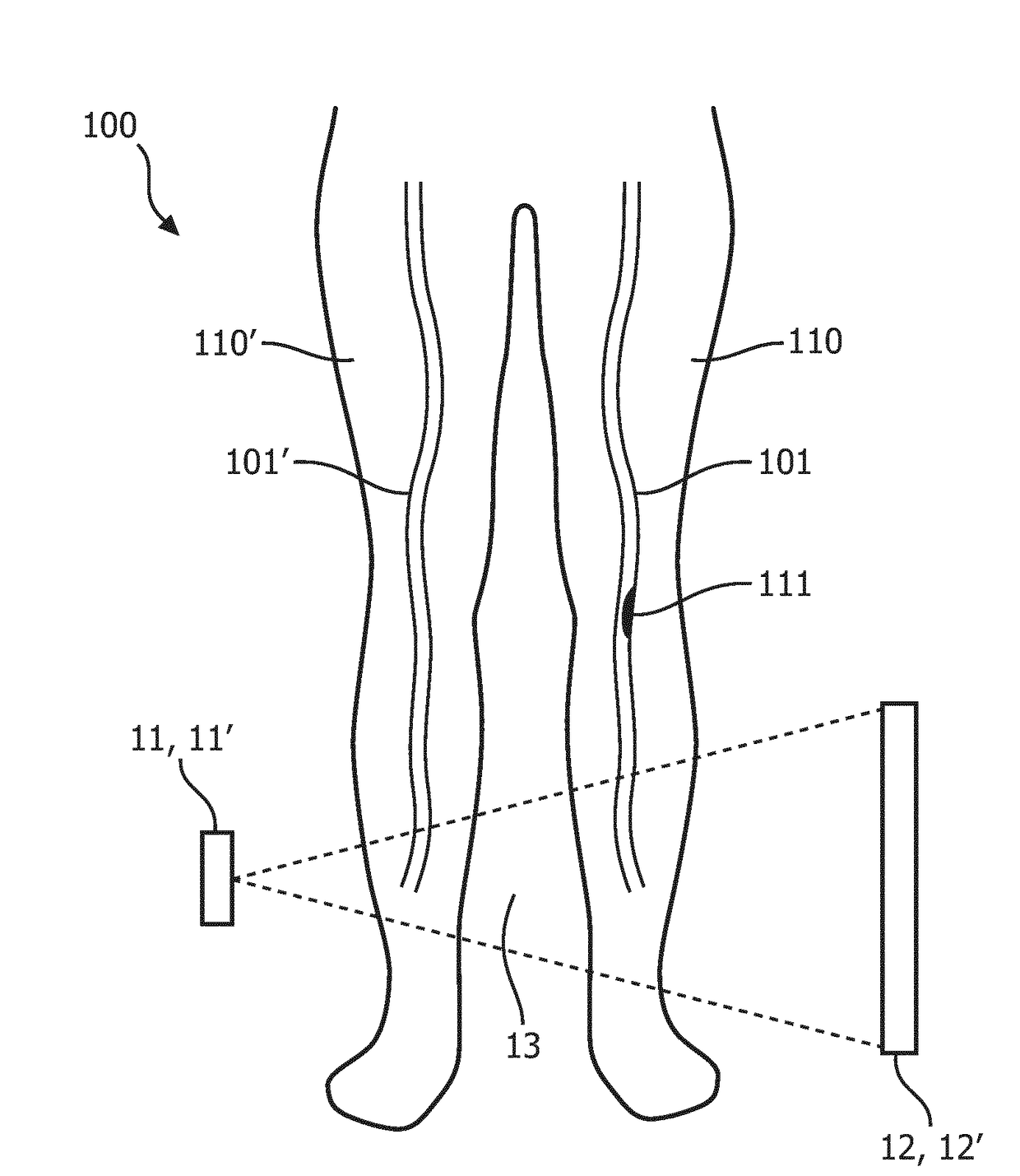 Stenosis assessment