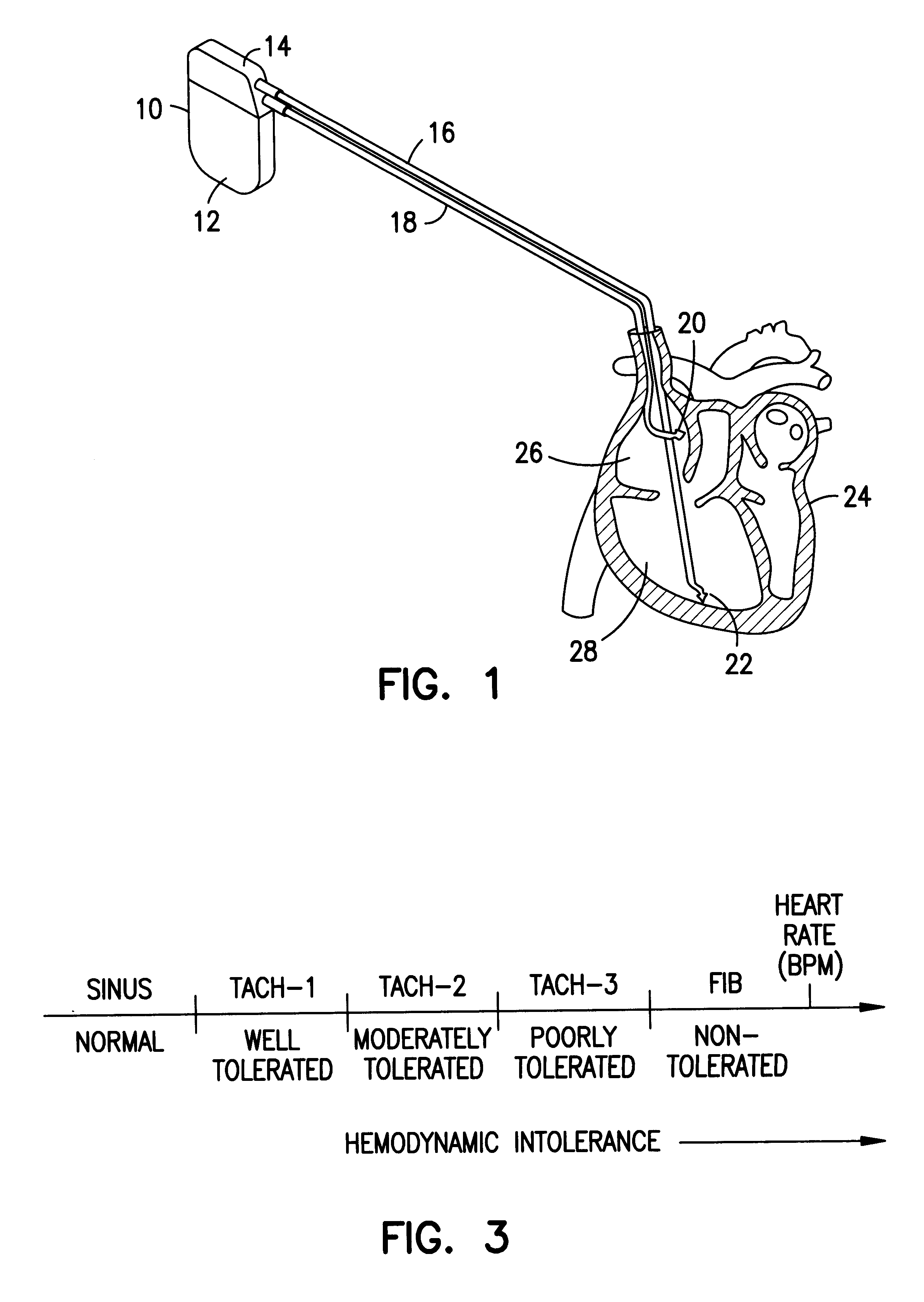 Methods and apparatus for treating fibrillation and creating defibrillation waveforms