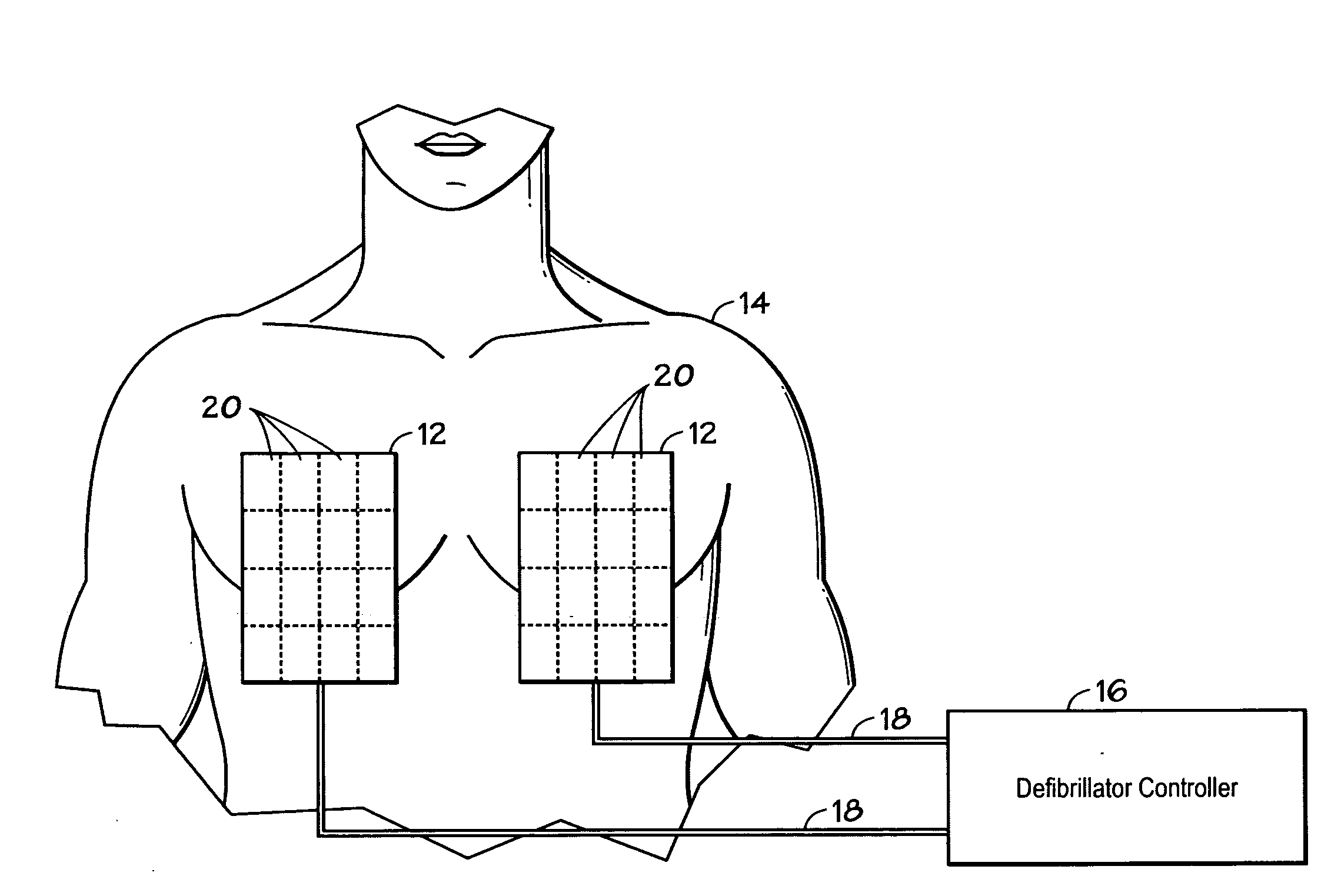 Method and system using MRI compatibility defibrillation pads