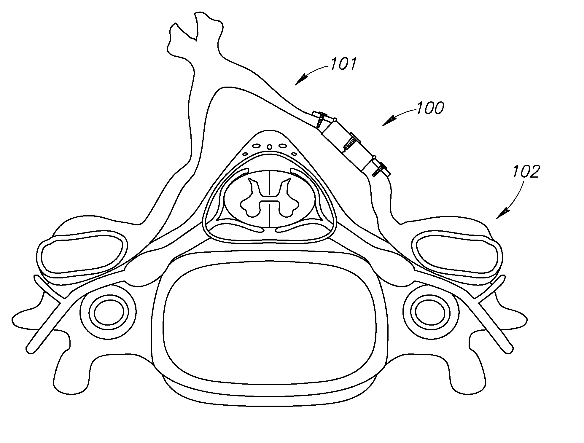 Device for expandable spinal laminoplasty