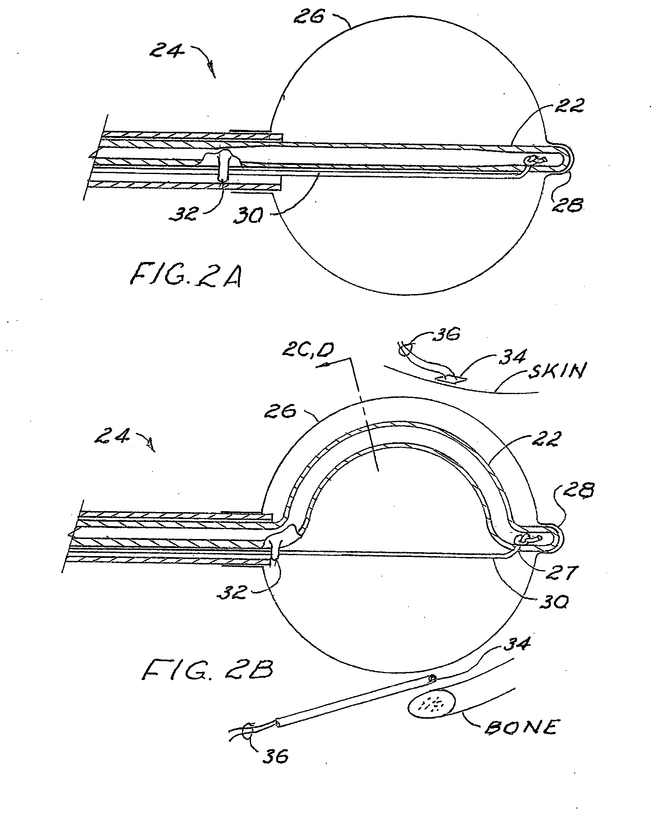 Brachytherapy apparatus and method using off-center radiation source