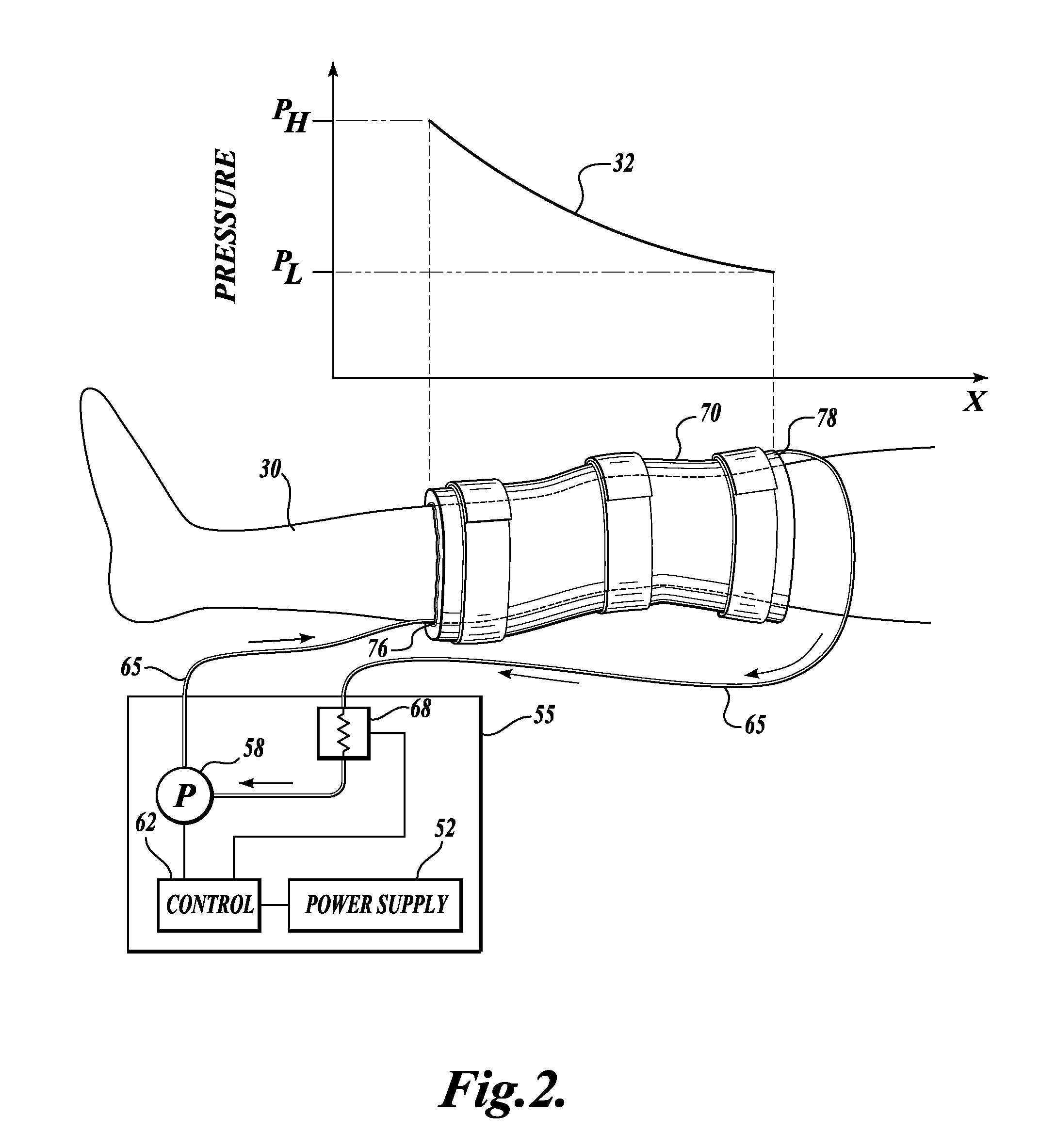 Device for treatment of edema