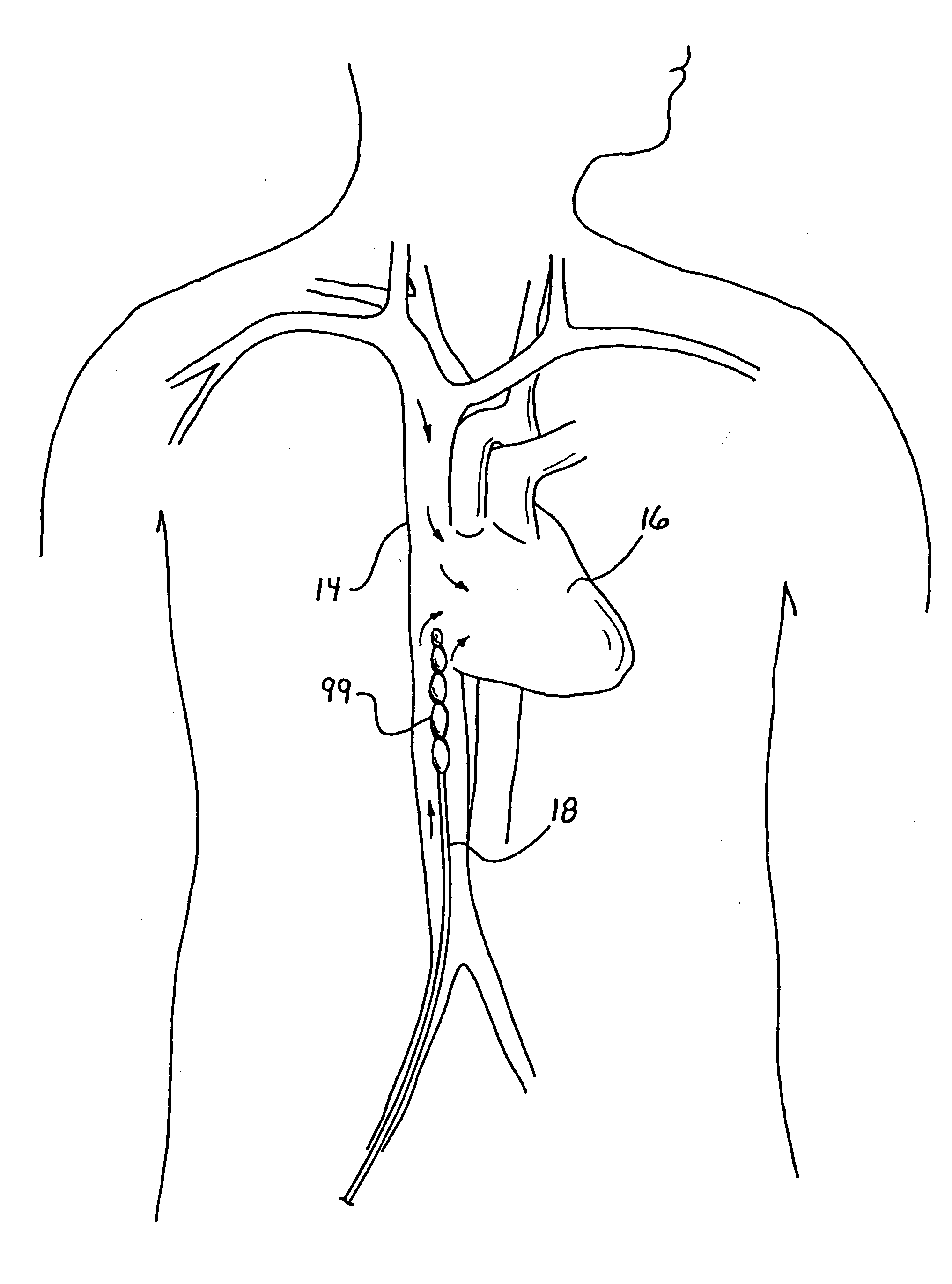 Method for reducing myocardial infarct by application of intravascular hypothermia