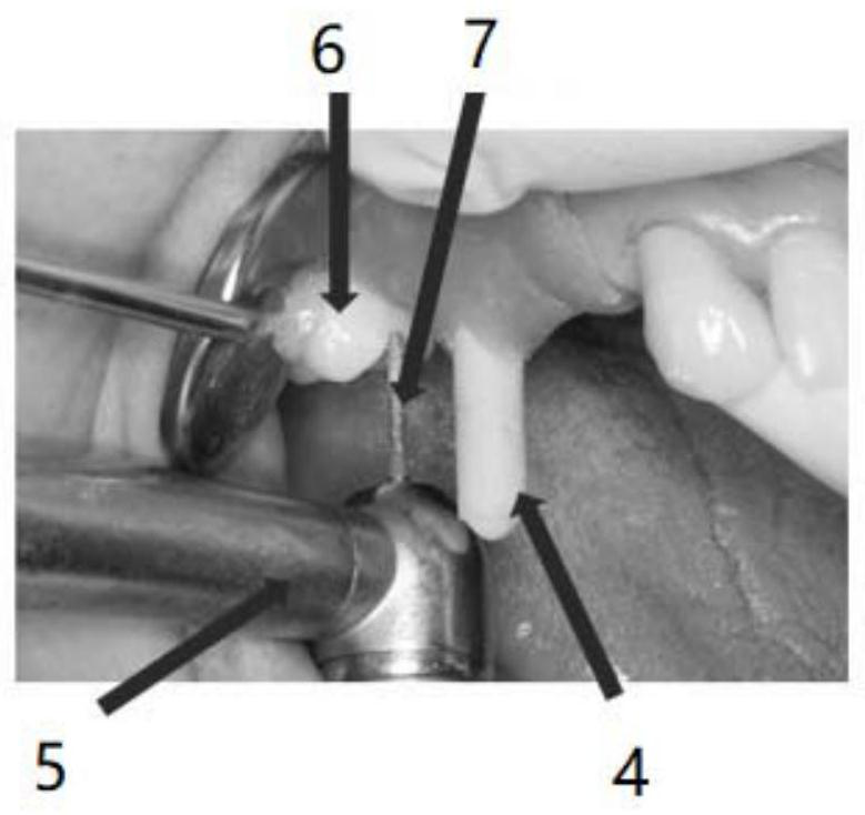 A digital transfer method and system for removable partial dentures in place