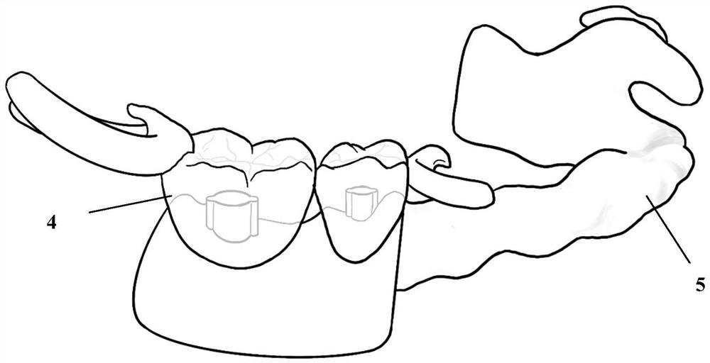 Digitized detachable nested removable partial denture