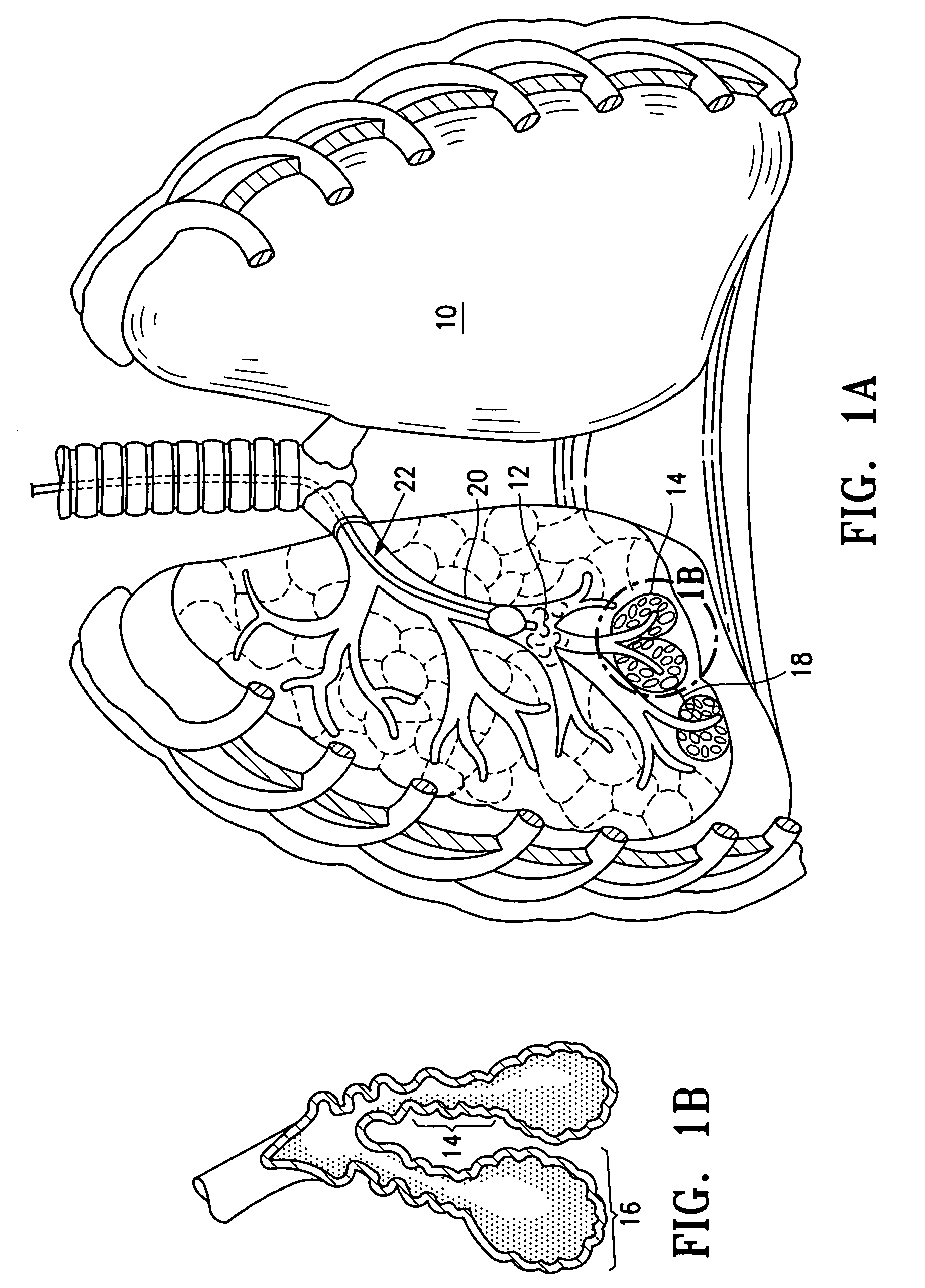 Device and method for lung treatment