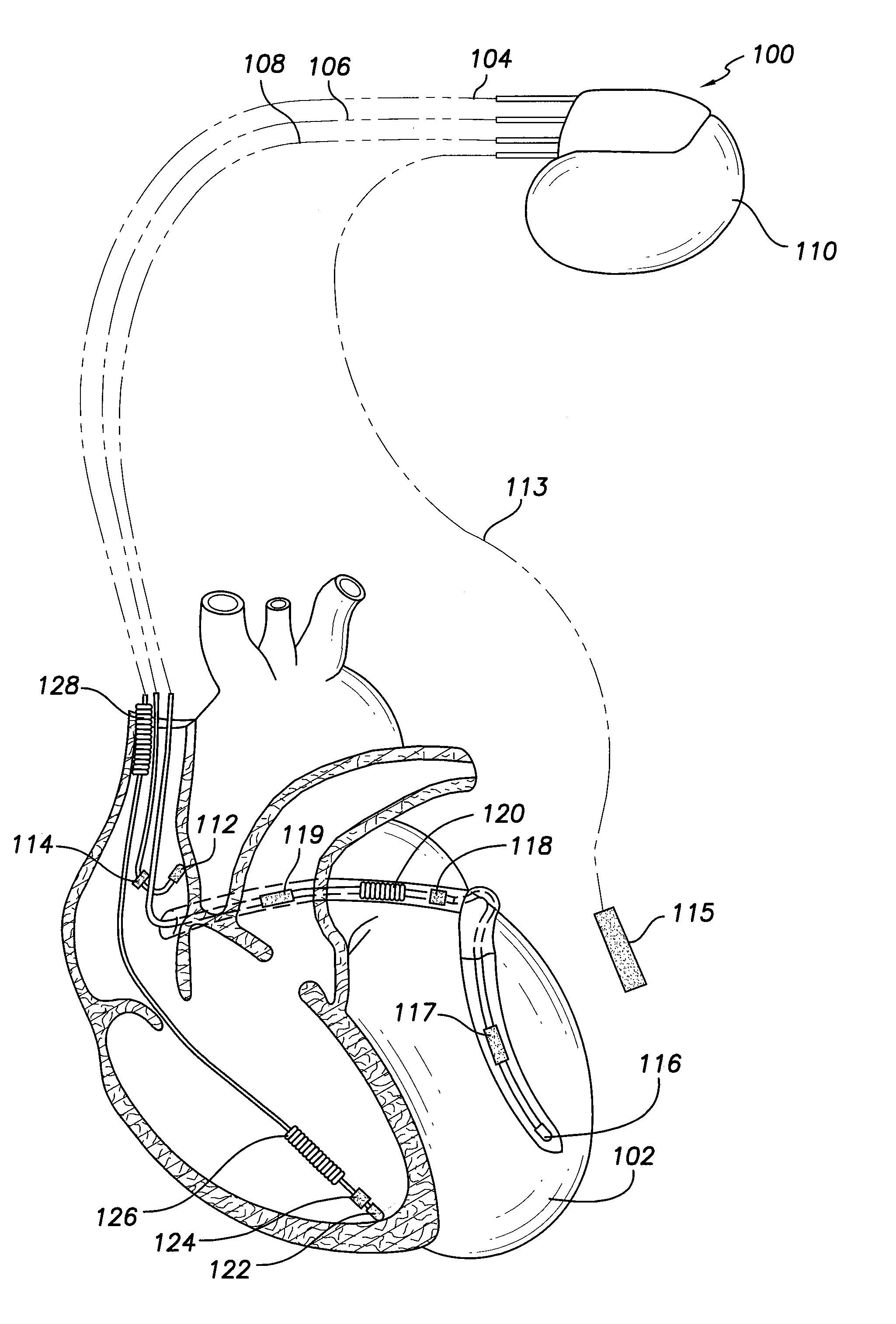 Method and system for identifying a potential lead failure in an implantable medical device