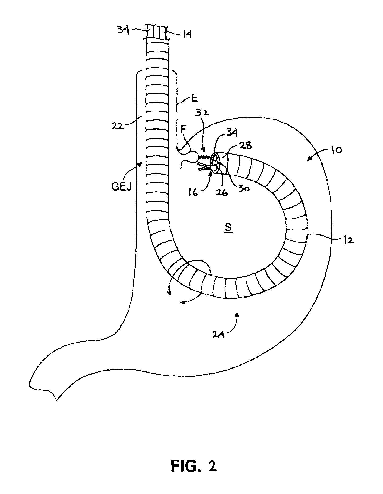 Methods and apparatus for revision of obesity procedures