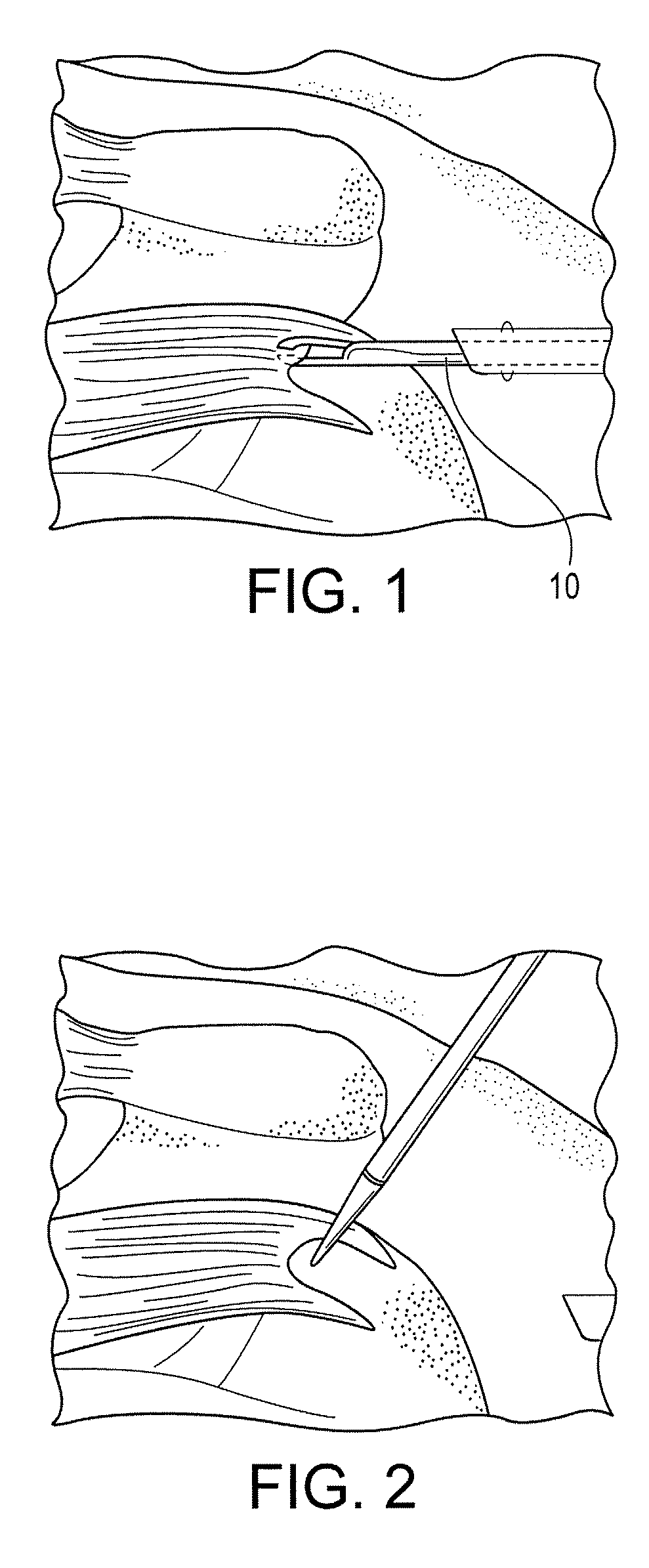 Self-punching swivel anchor and method for knotless fixation of tissue