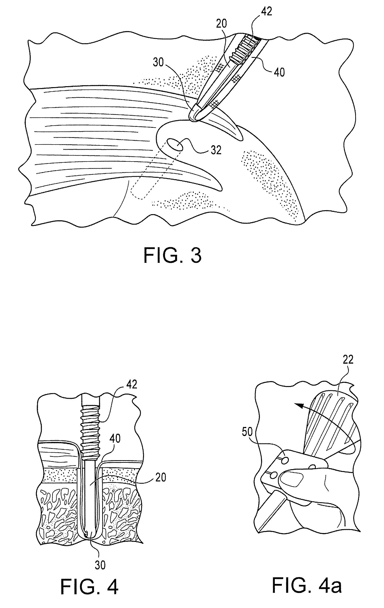 Self-punching swivel anchor and method for knotless fixation of tissue