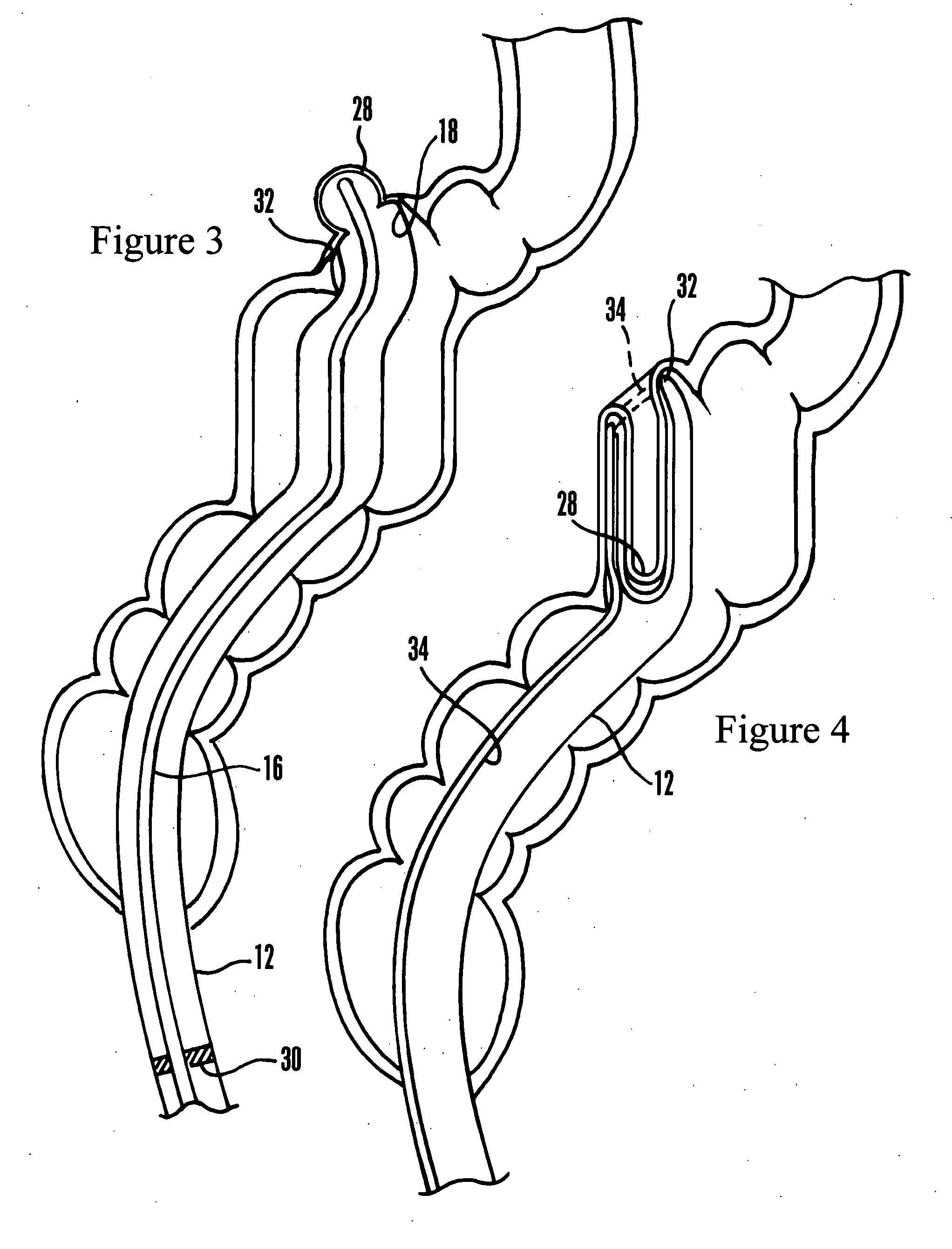 Systems and methods for endoscopic treatment of diverticula
