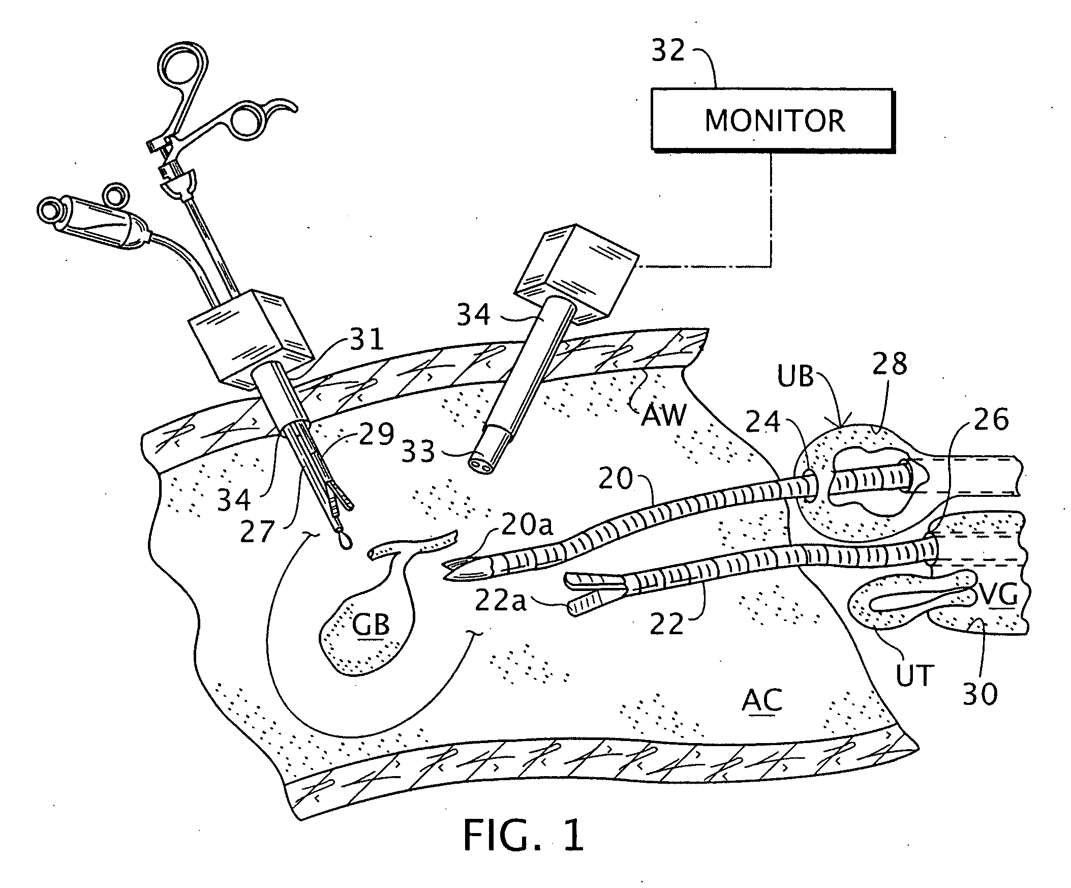 Intra-abdominal medical procedures and device